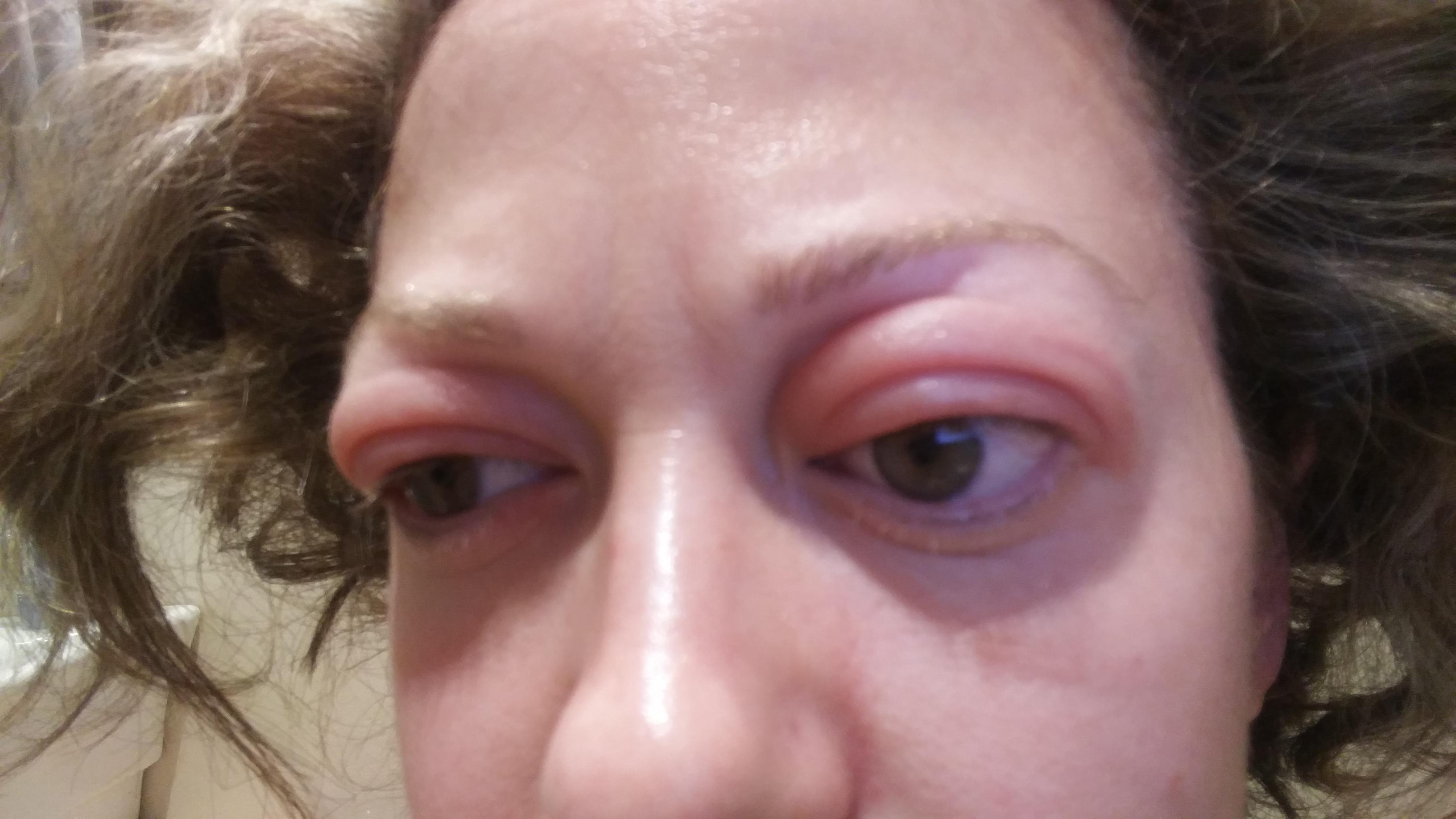 Anyone Get An Allergic Reaction On Their Eyelids? My Makeup Hasn't Changed And This Has Happened Before. : R/Allergies