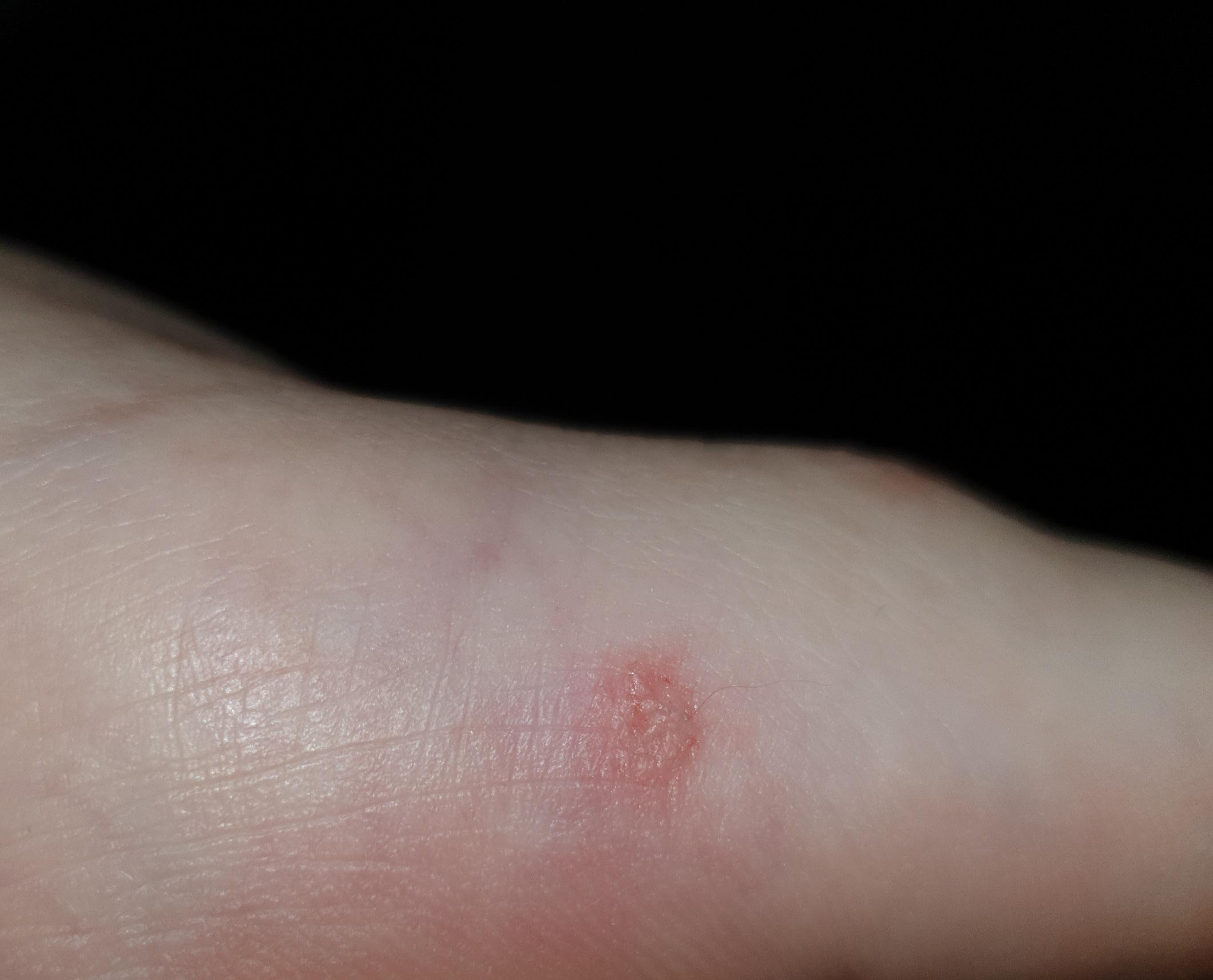 Slugs can bite! mildlyinteresting