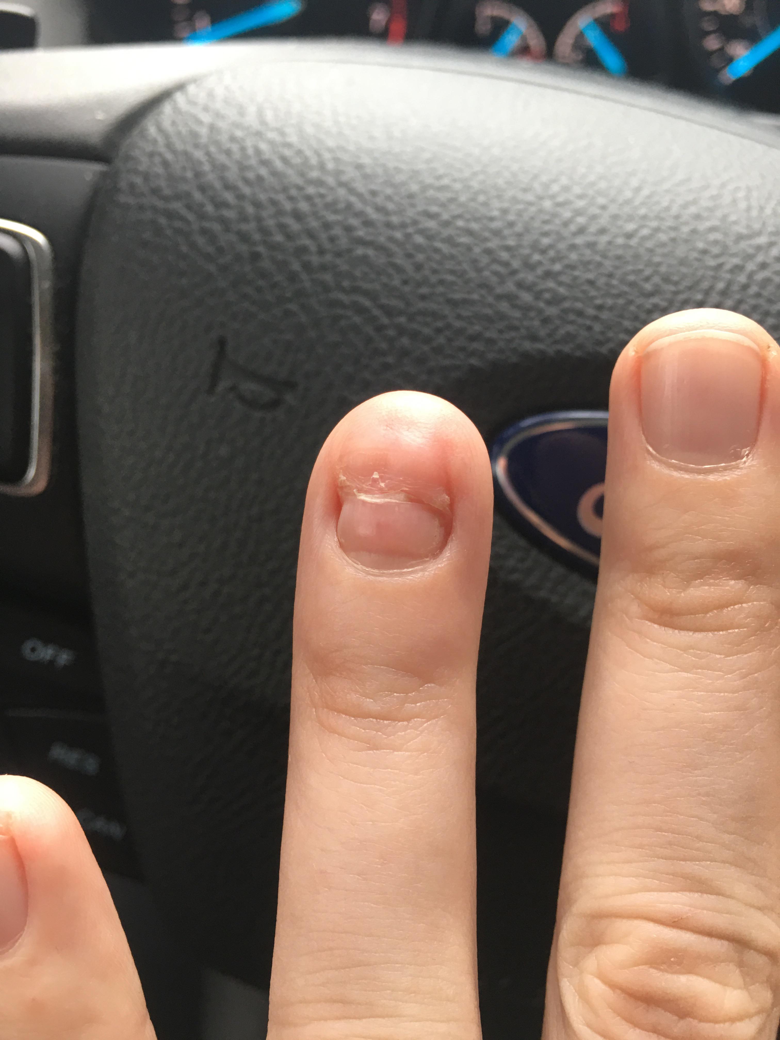 Lost my fingernail. This is 2 months of regrowth. r/mildlyinteresting