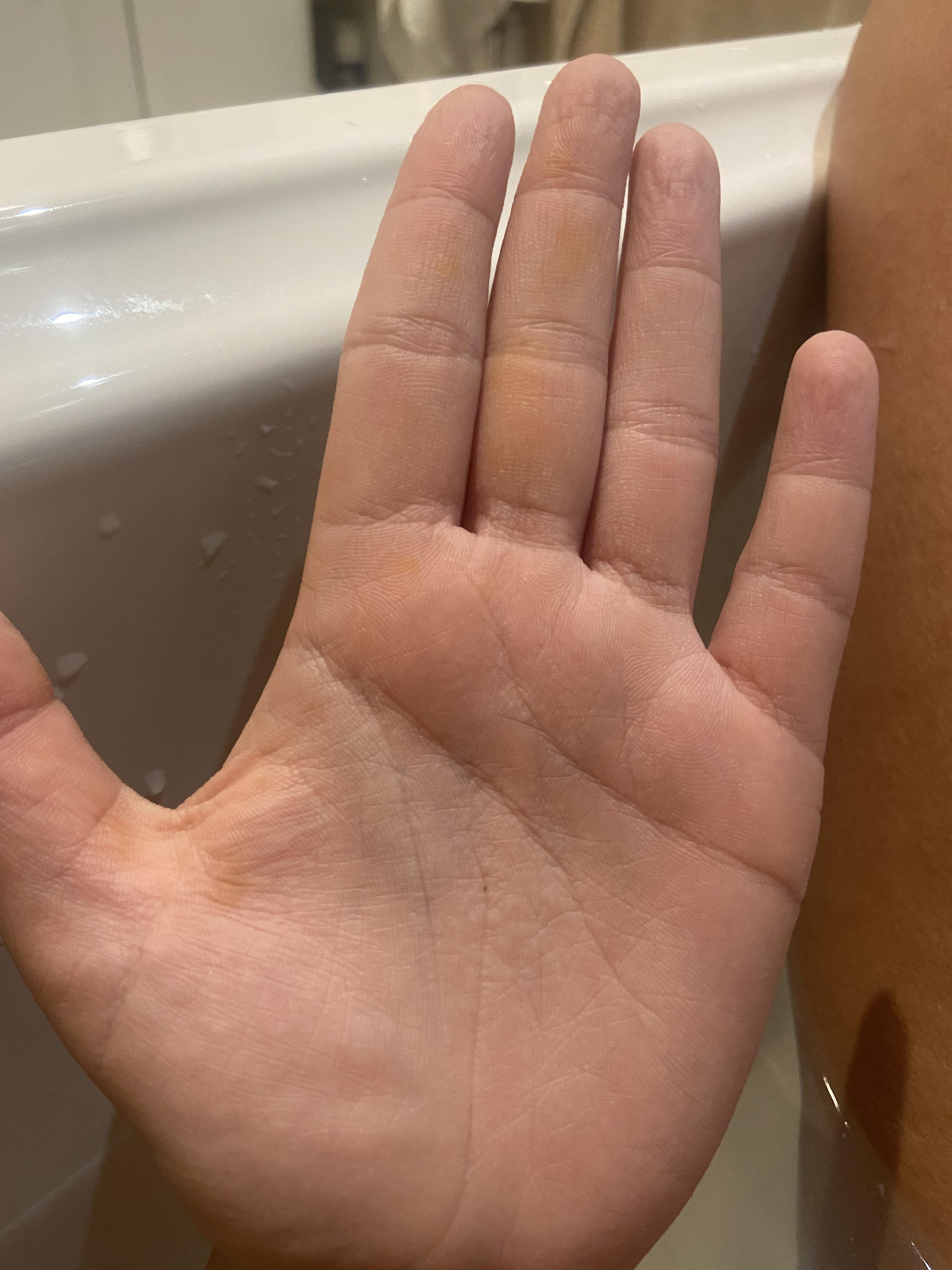 What are these rust coloured marks on my hands? r/medical_advice