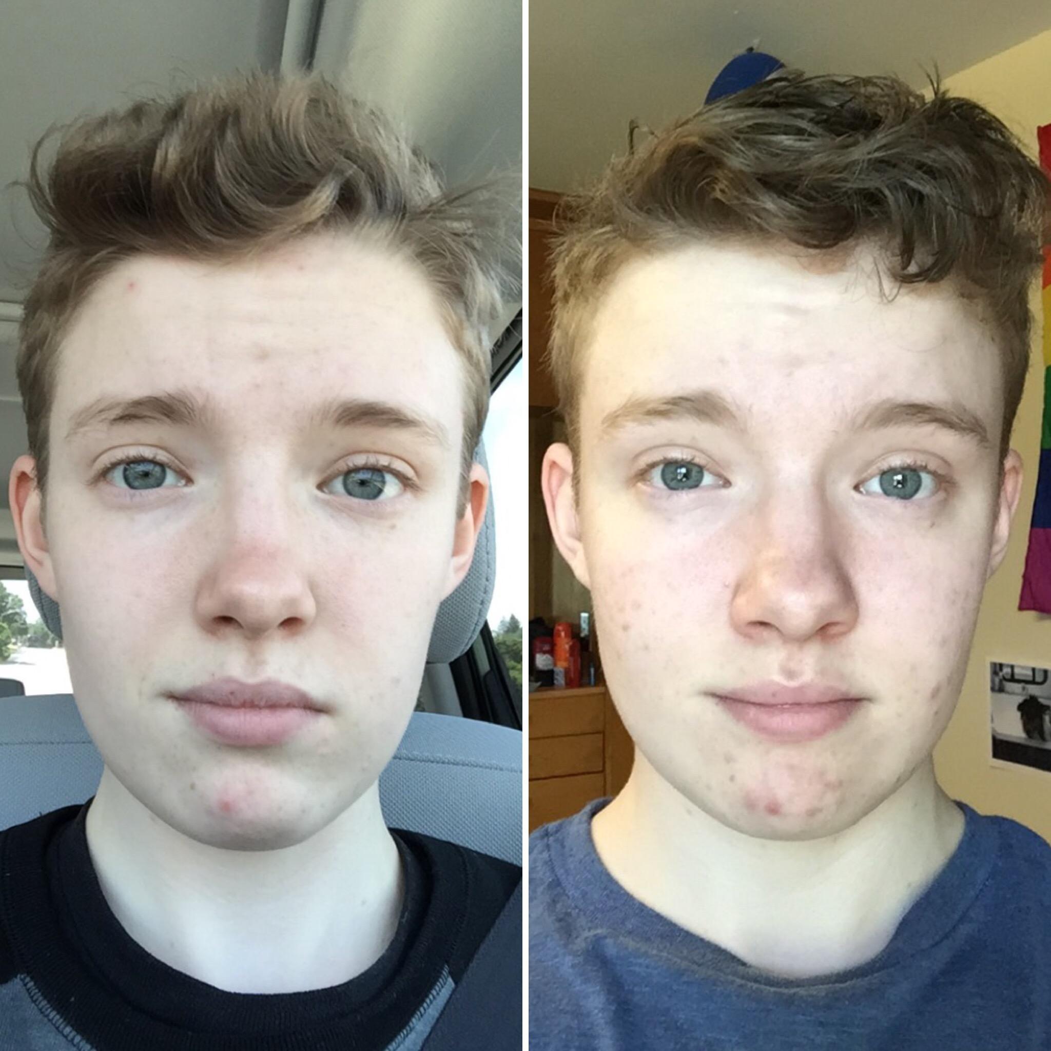 Ftm Before And After Face