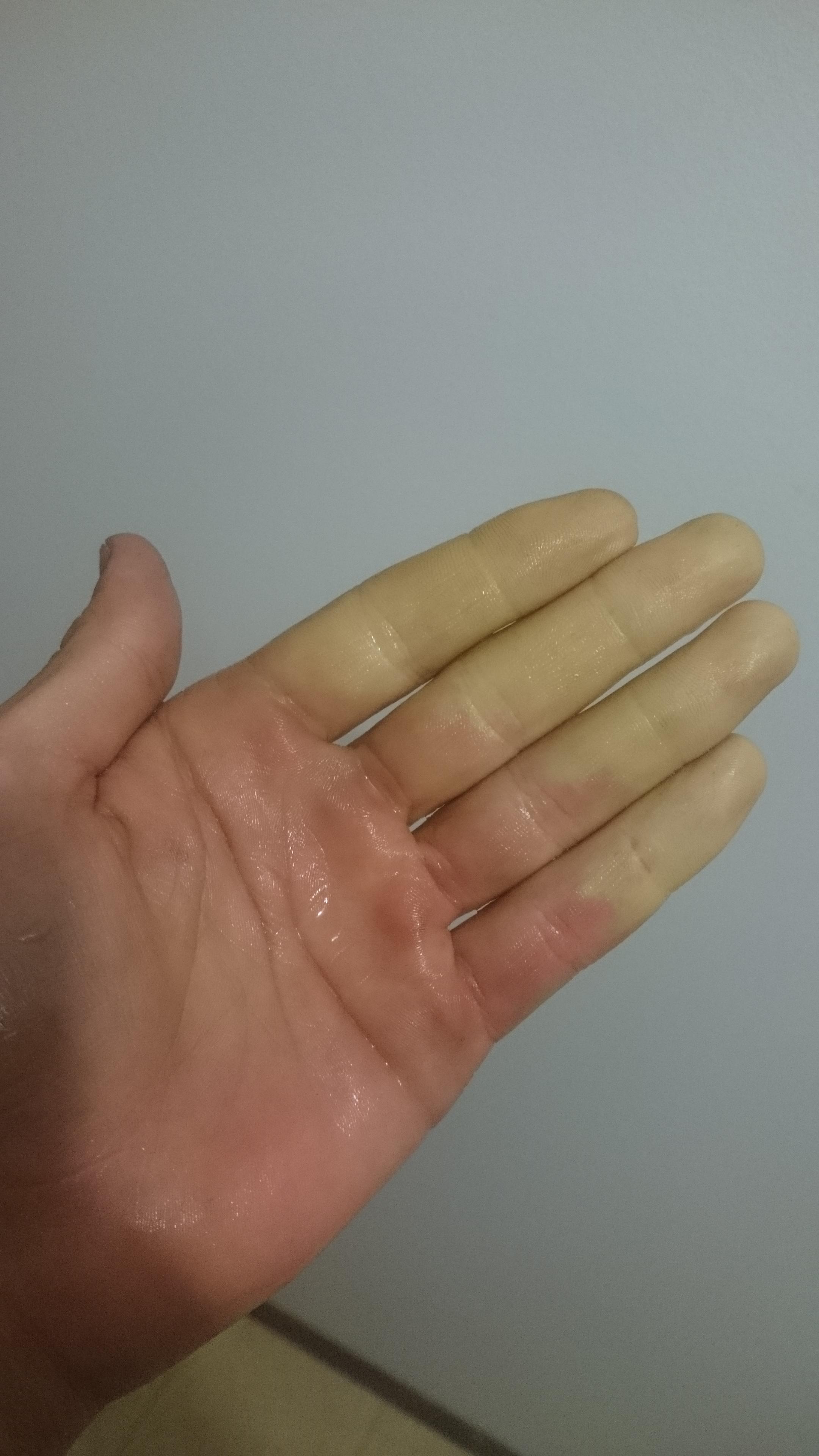 Raynaud syndrome