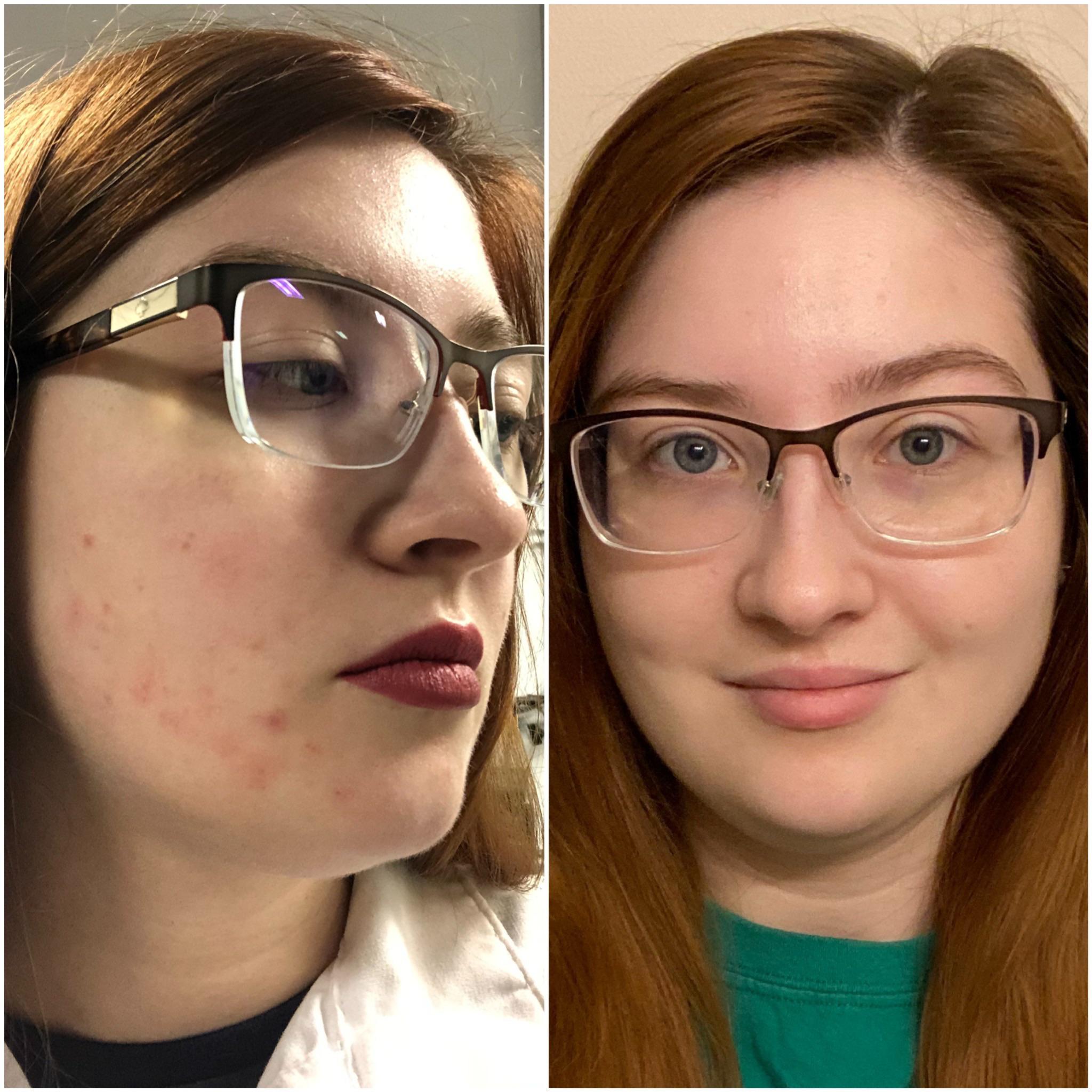 [Before & After] Restored my super dry sensitive skin to flawlessness
