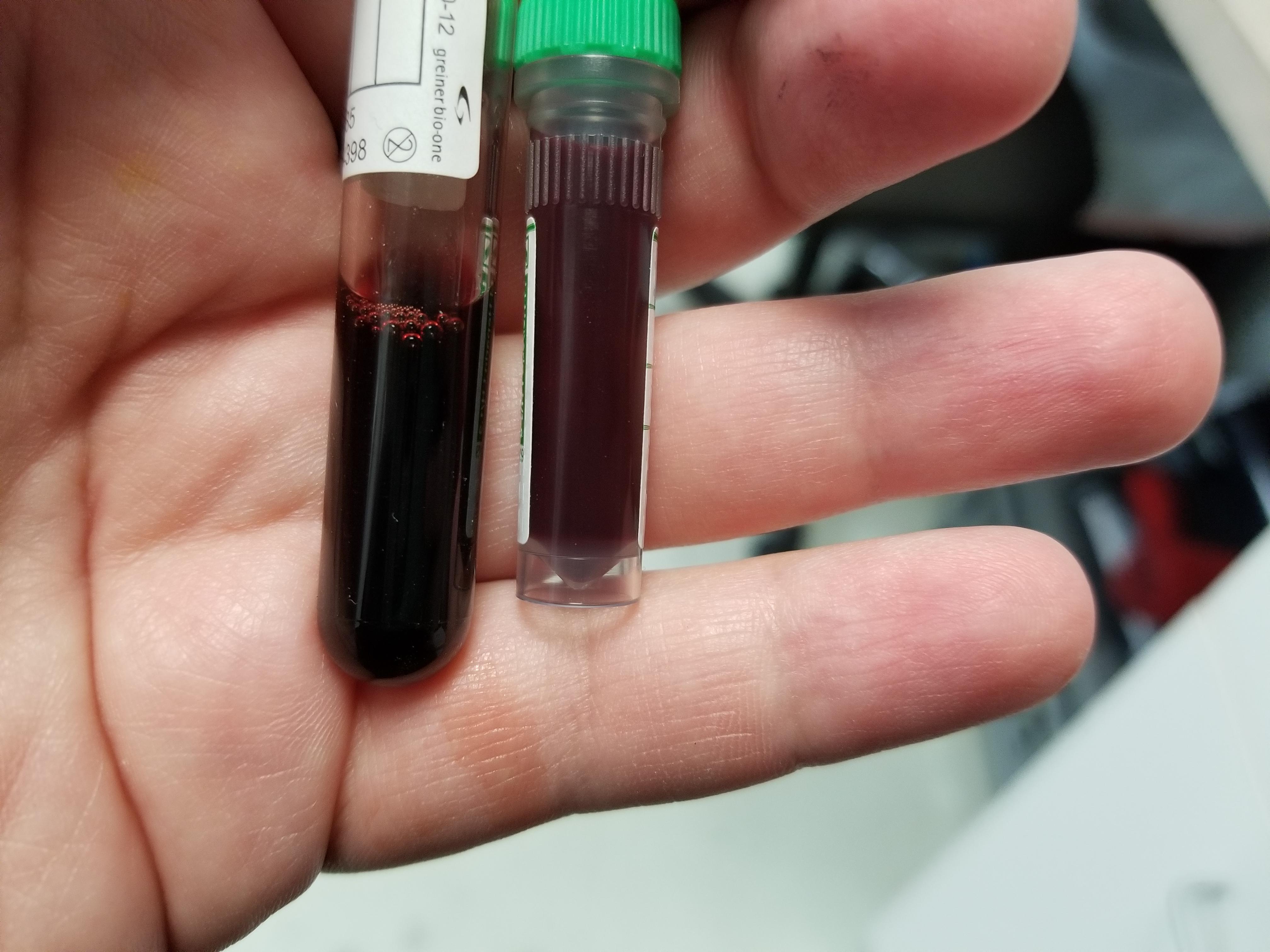 Came in for bloody urine. No blood on sediment. Diagnosed with