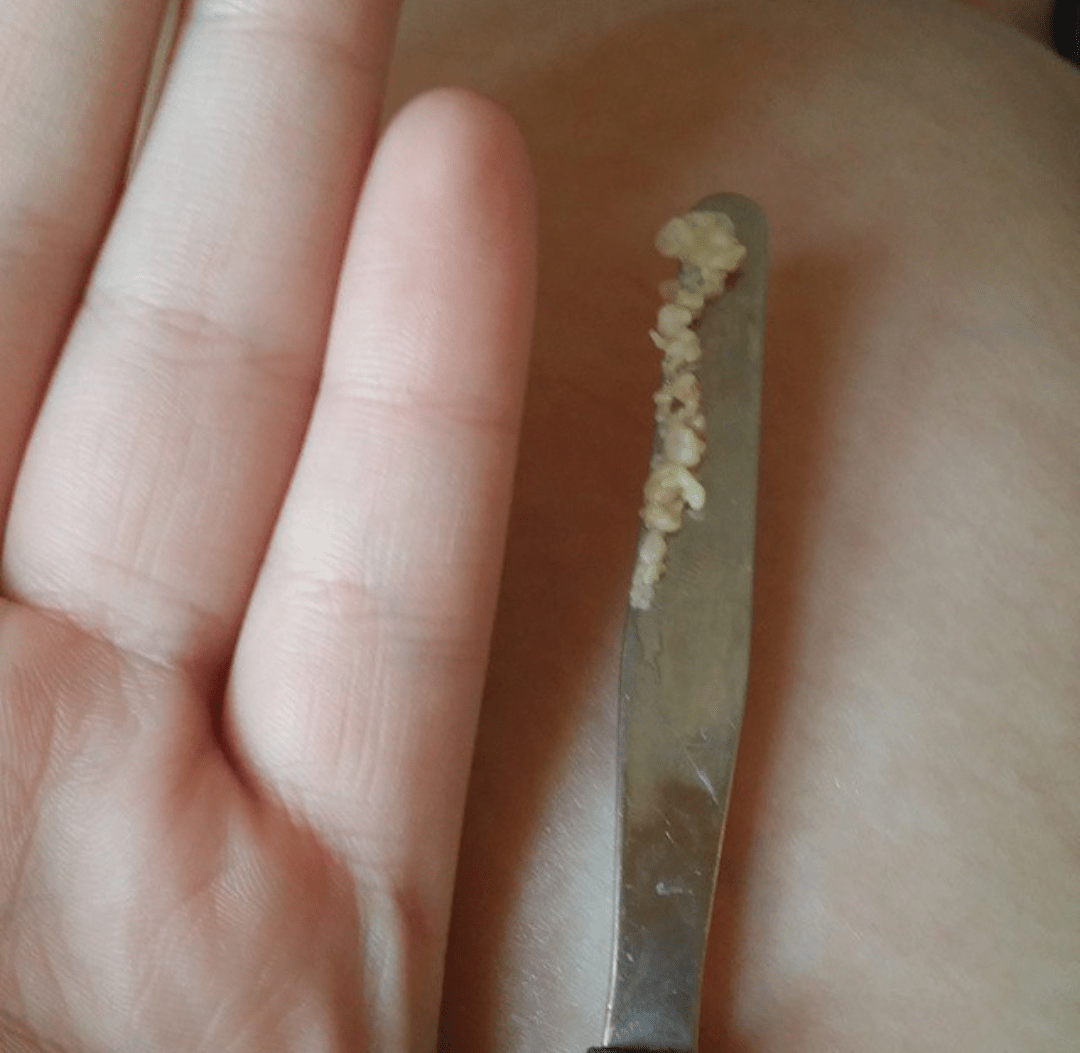 How To Cough Up Tonsil Stones Reddit bronchitis contagious