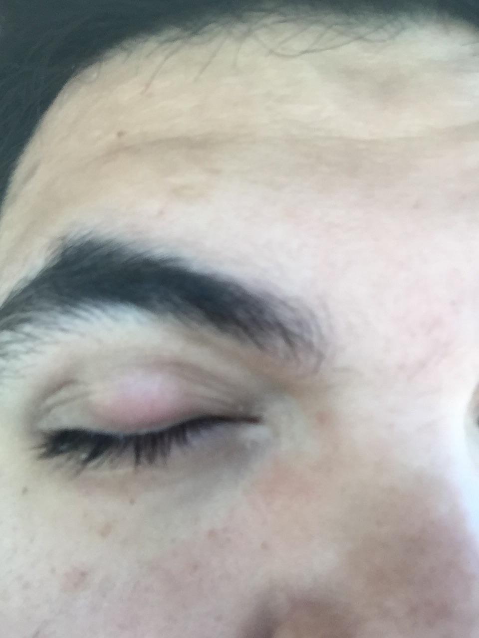 I have a Chalazion surgery coming up and I am terrified. How long is