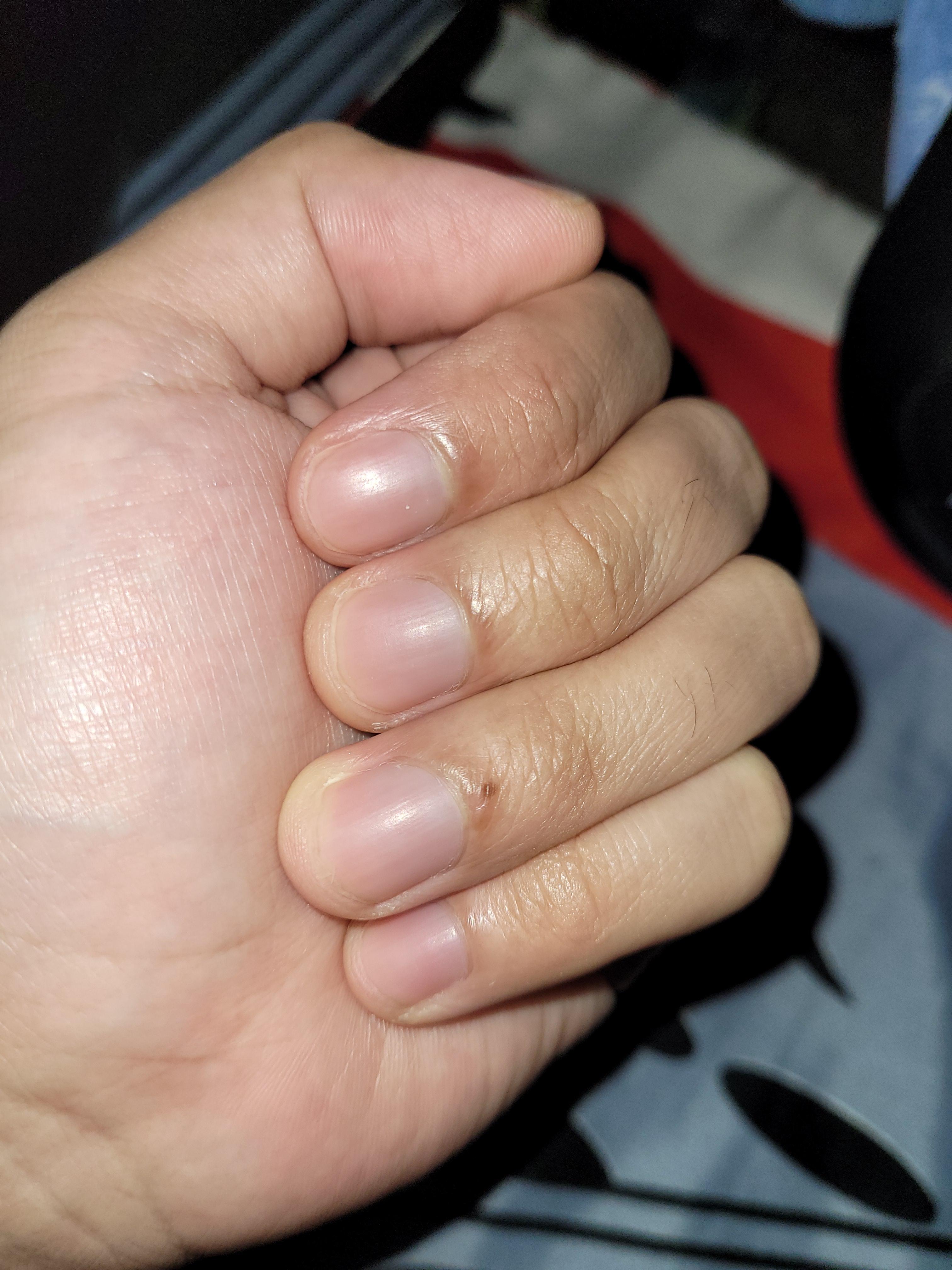 Hello may i know if i have a cyanosis on my nail beds?got a pulse