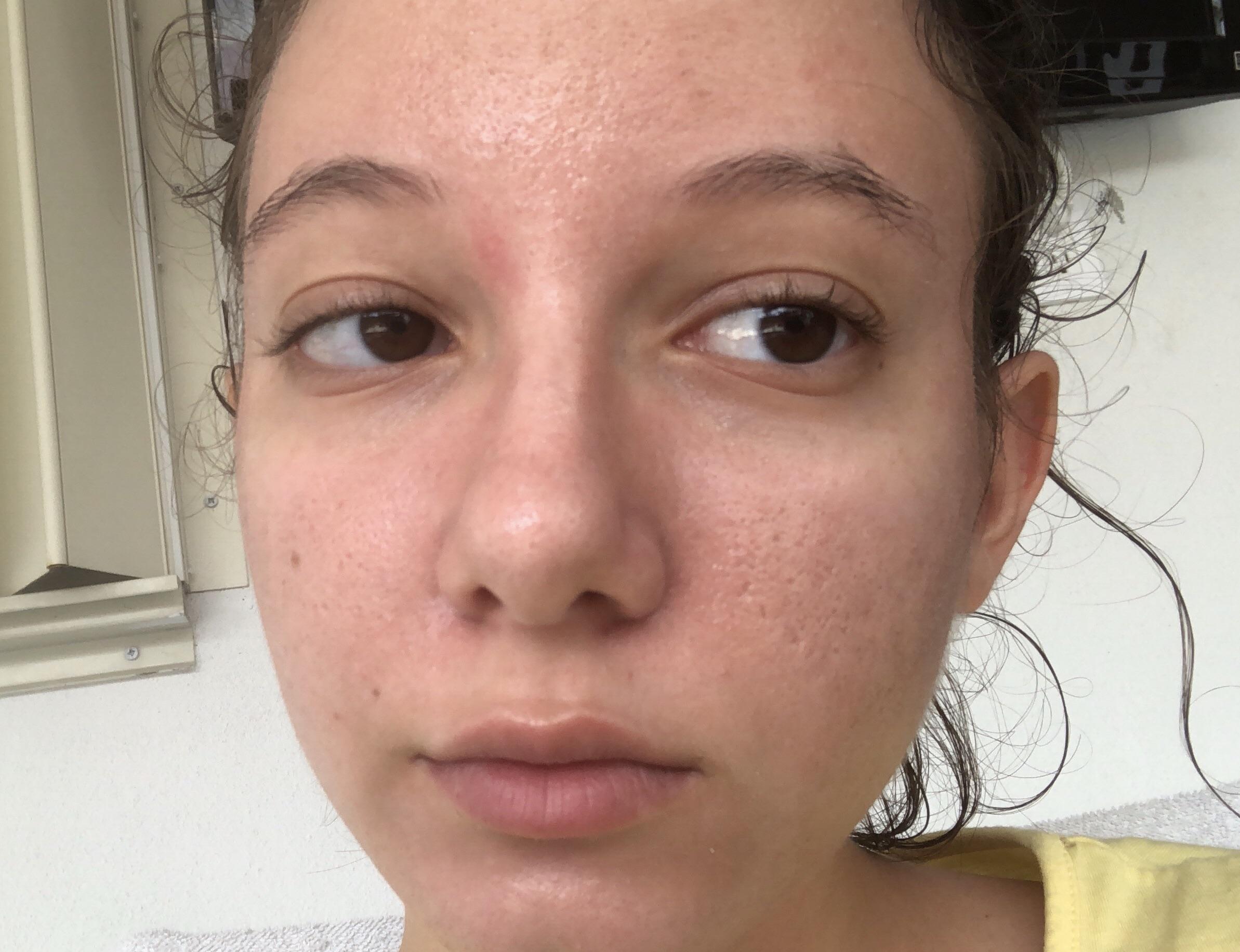 [Routine Help] Help w skin texture and am I overexfoliating ? (Routine in comments) r