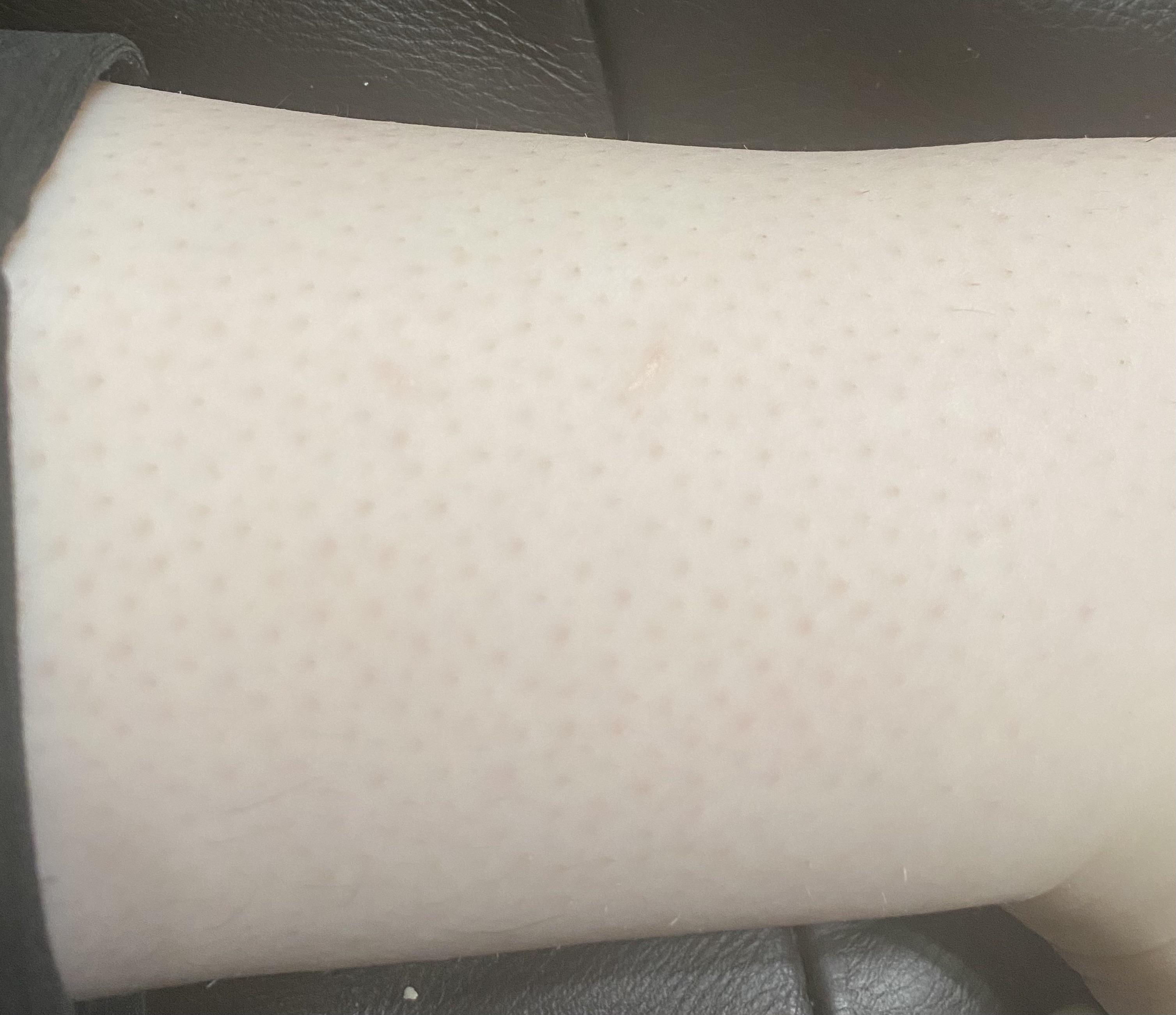 [Skin Concern] Remedies for strawberry legs? I tried glycolic acid soap