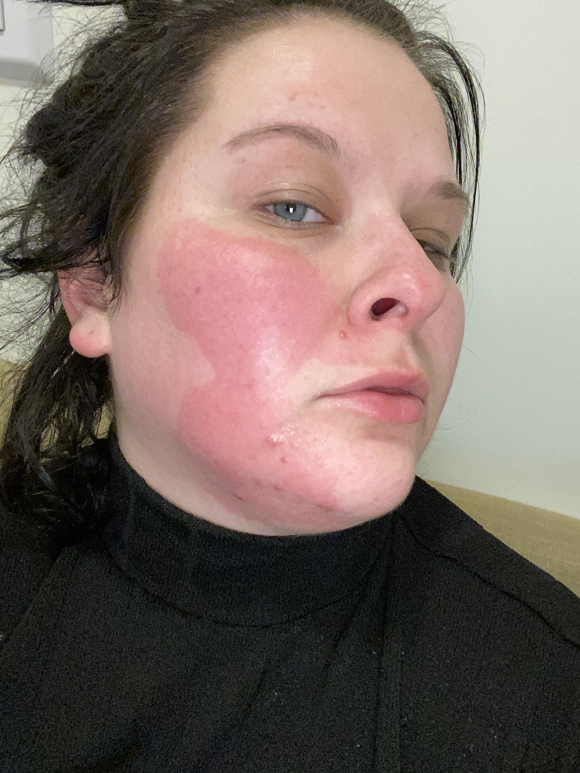 [acne] I’m gonna go out of on a limb here and say benzoyl peroxide is not for me. r
