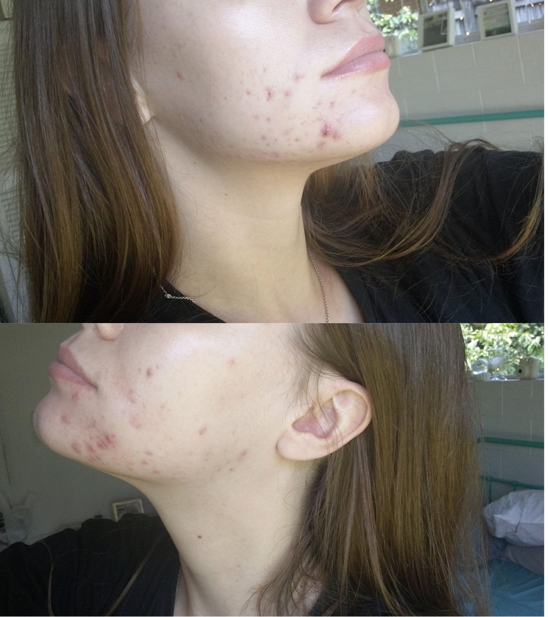 I'm done fighting acne topicals, antibiotics, birth control, and