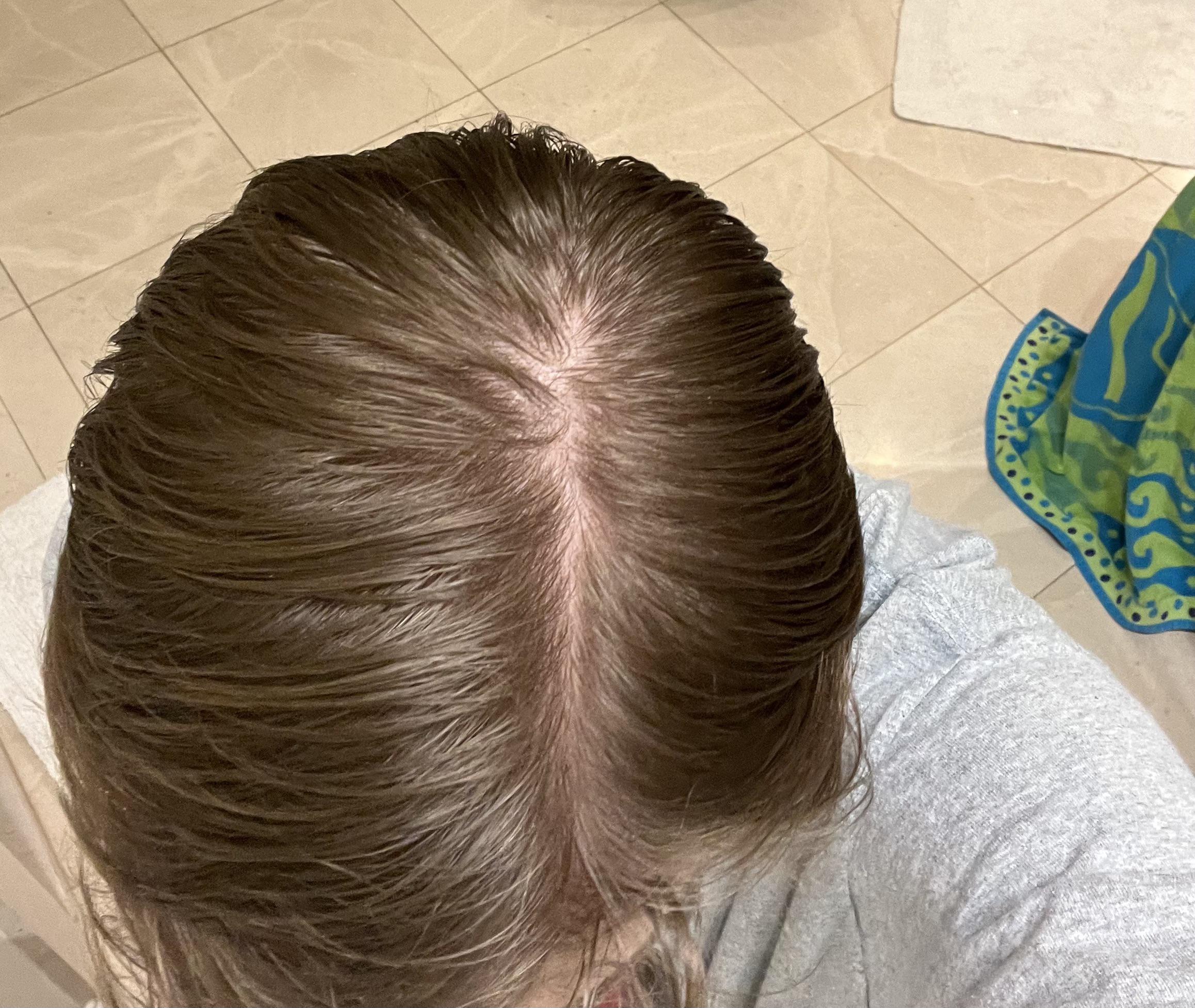 Is this beginning stages of hair loss or a normal part? Hair has always