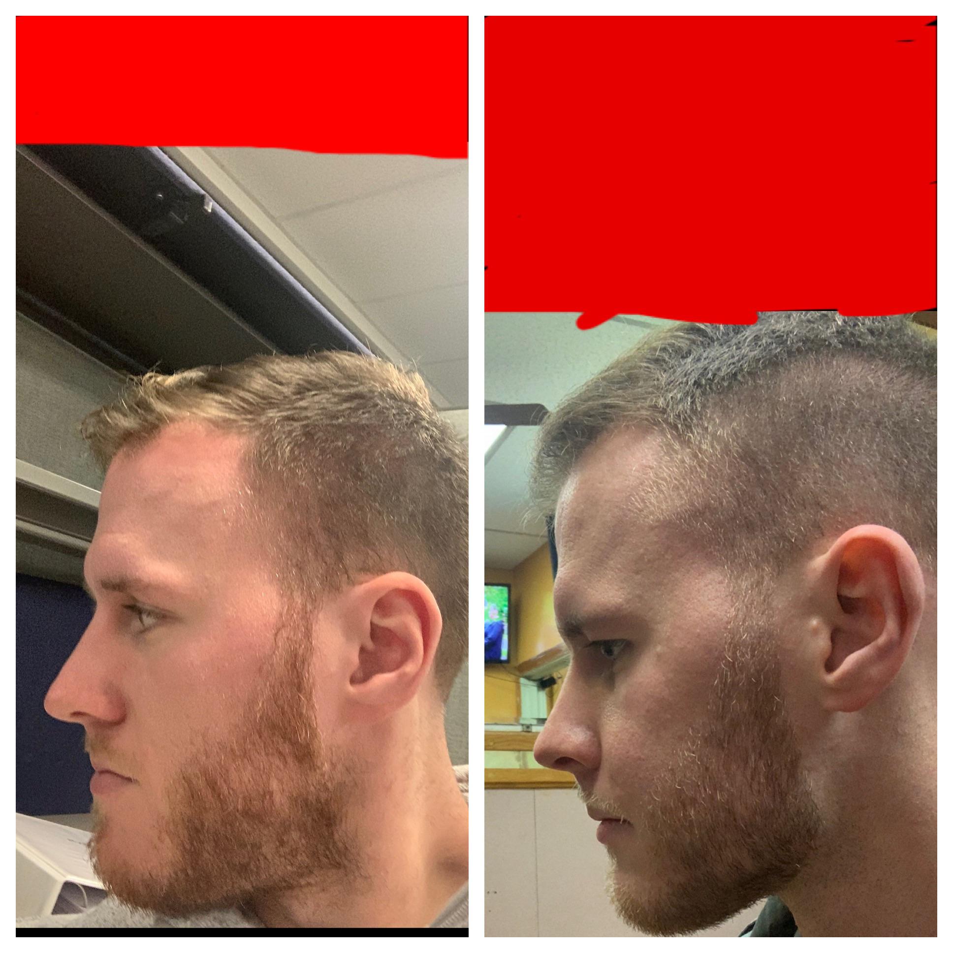 Before and after my jaw surgery (Le Fort 1) and braces. 1 month post op