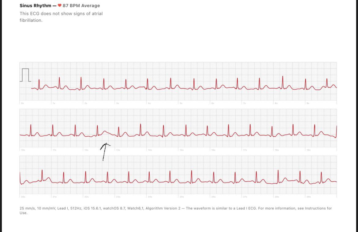 Normal? Sharp pain left side of chest (more details in comments but