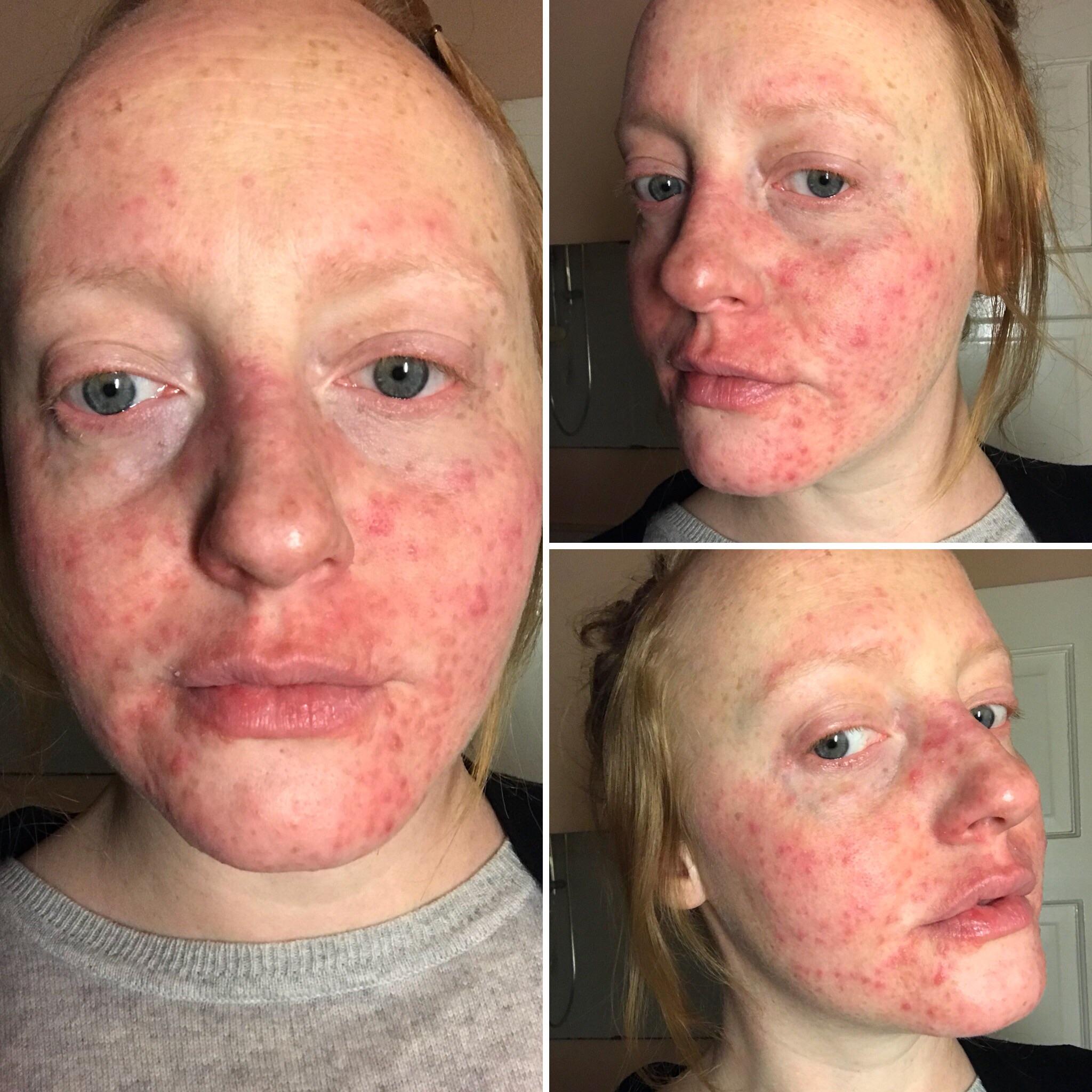 [Routine Help] [Personal] I’m a kidney transplant patient