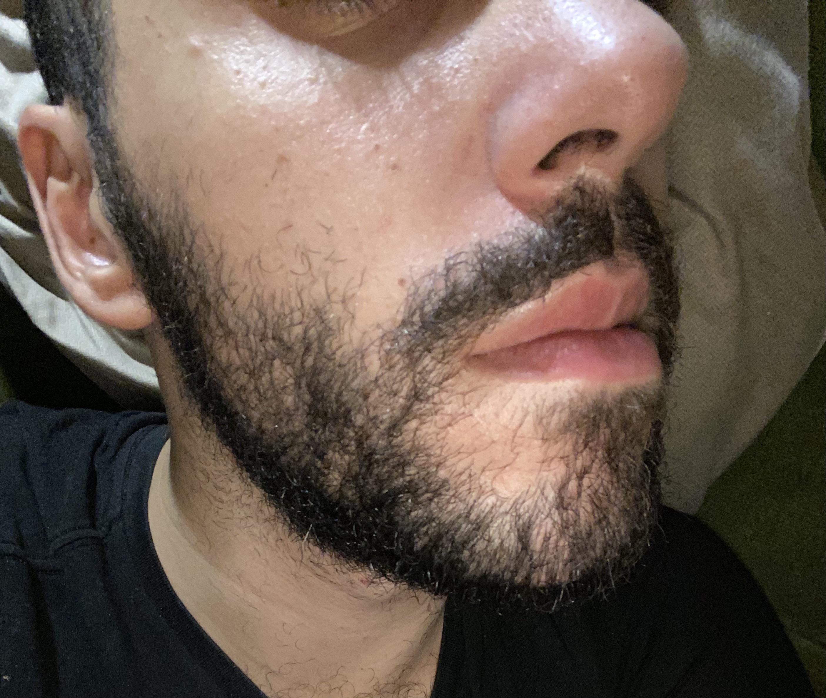 Beard day 38, from day 5 it's hurting, itching, tingling and stiff