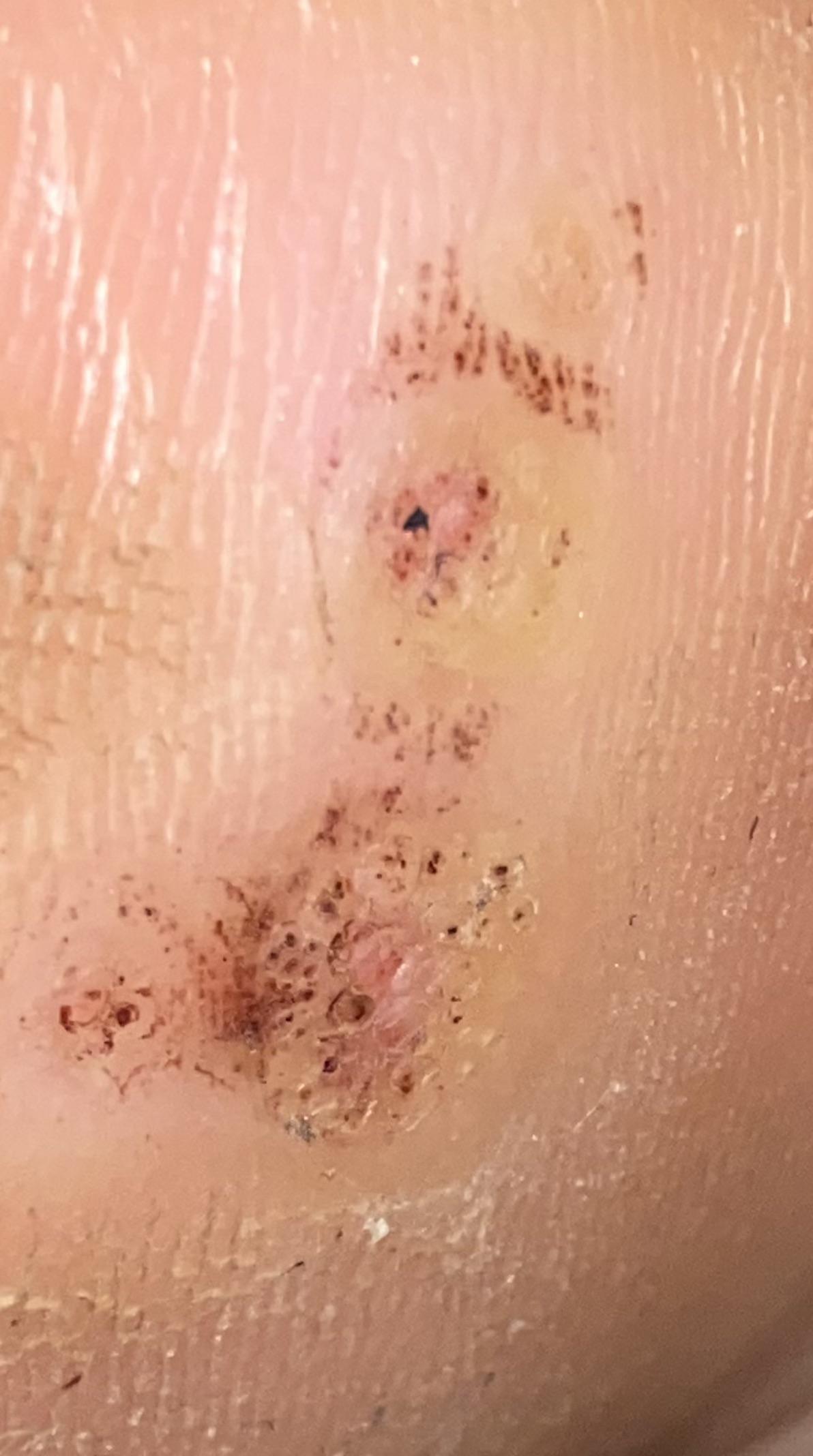 I’ve been trying to get rid of these plantar warts for awhile now. Did