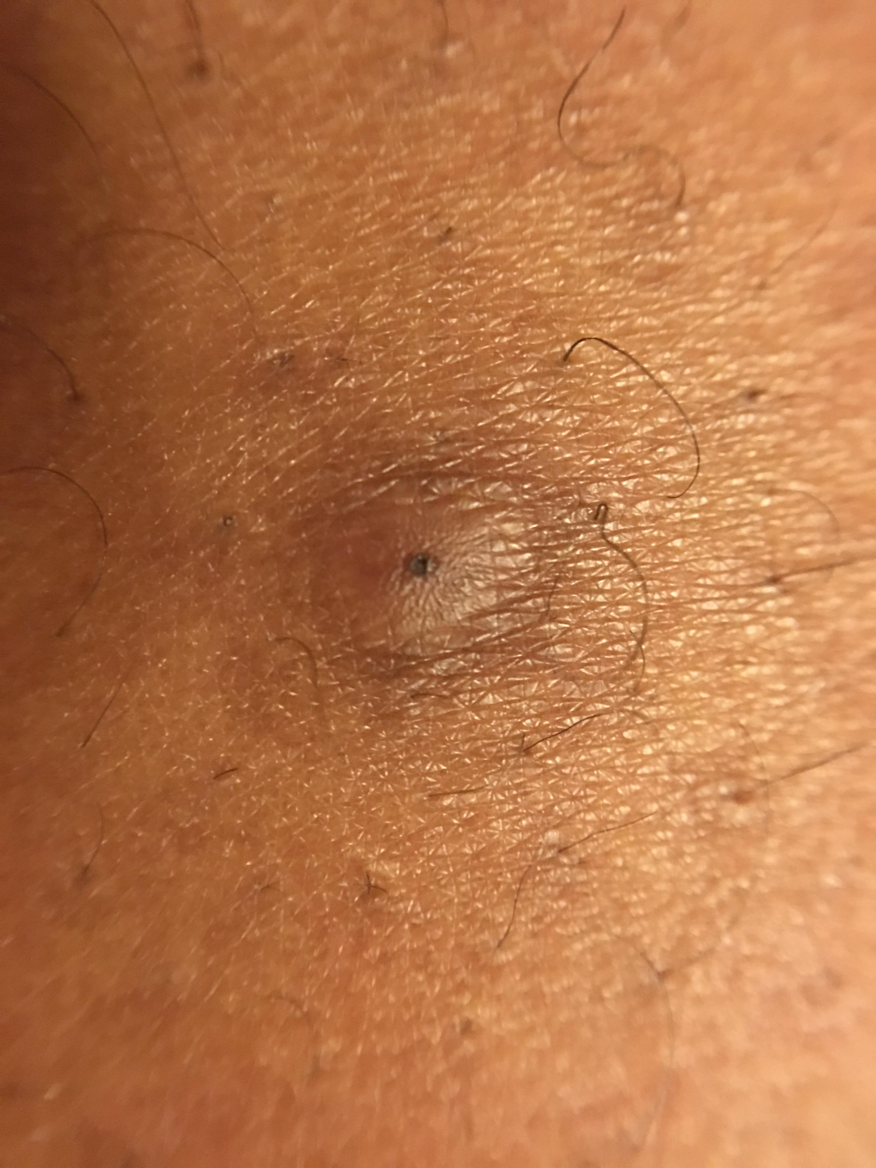 Can You Have An Ingrown Hair For Years Ingrown Hair