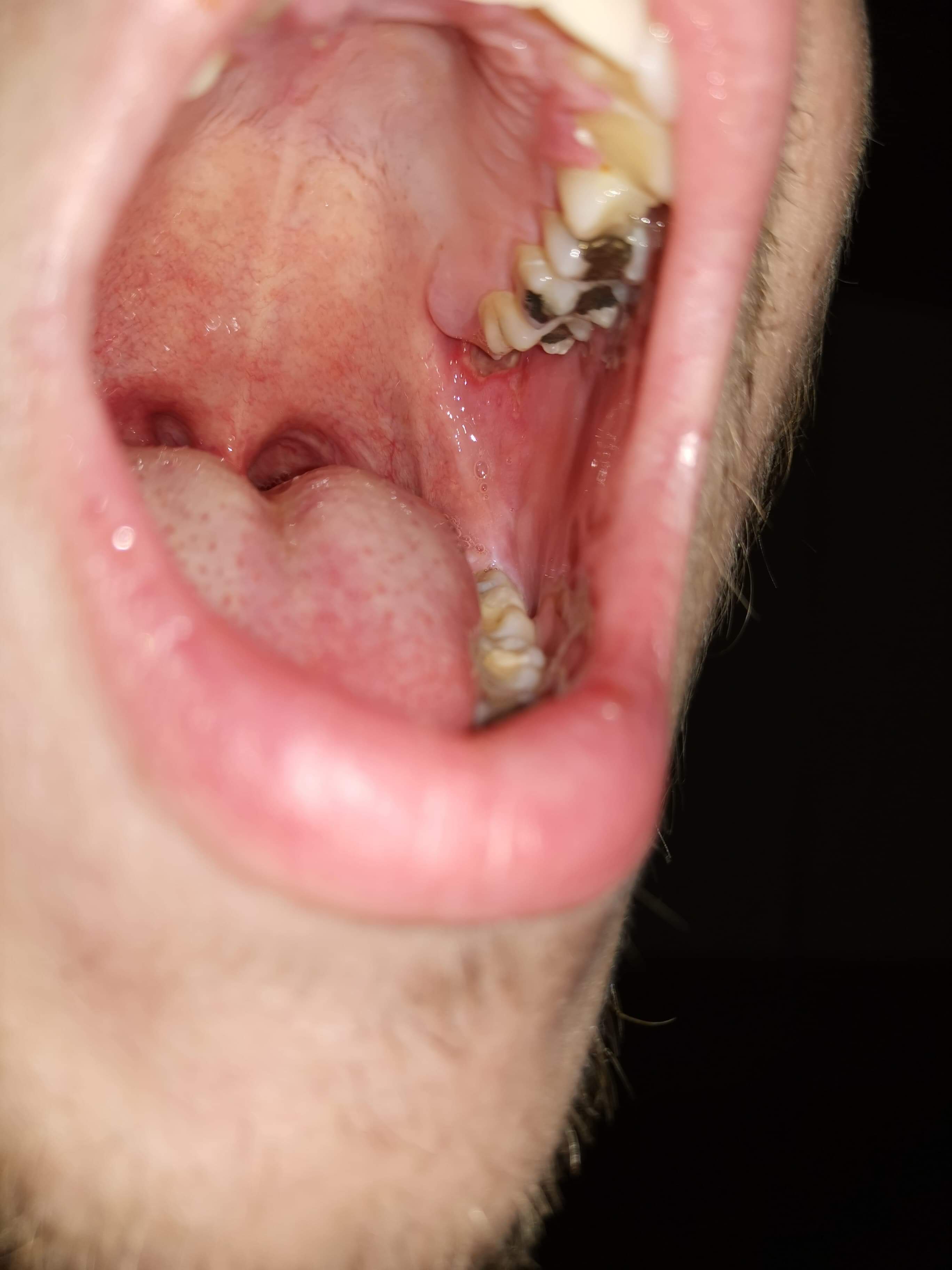 Guys, please help! Wisdom tooth made me a crater like hole in my mouth