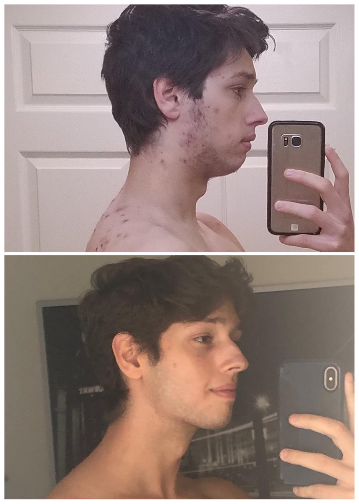 1522 best Cystic images on Pholder Radiology, Skincare Addiction and