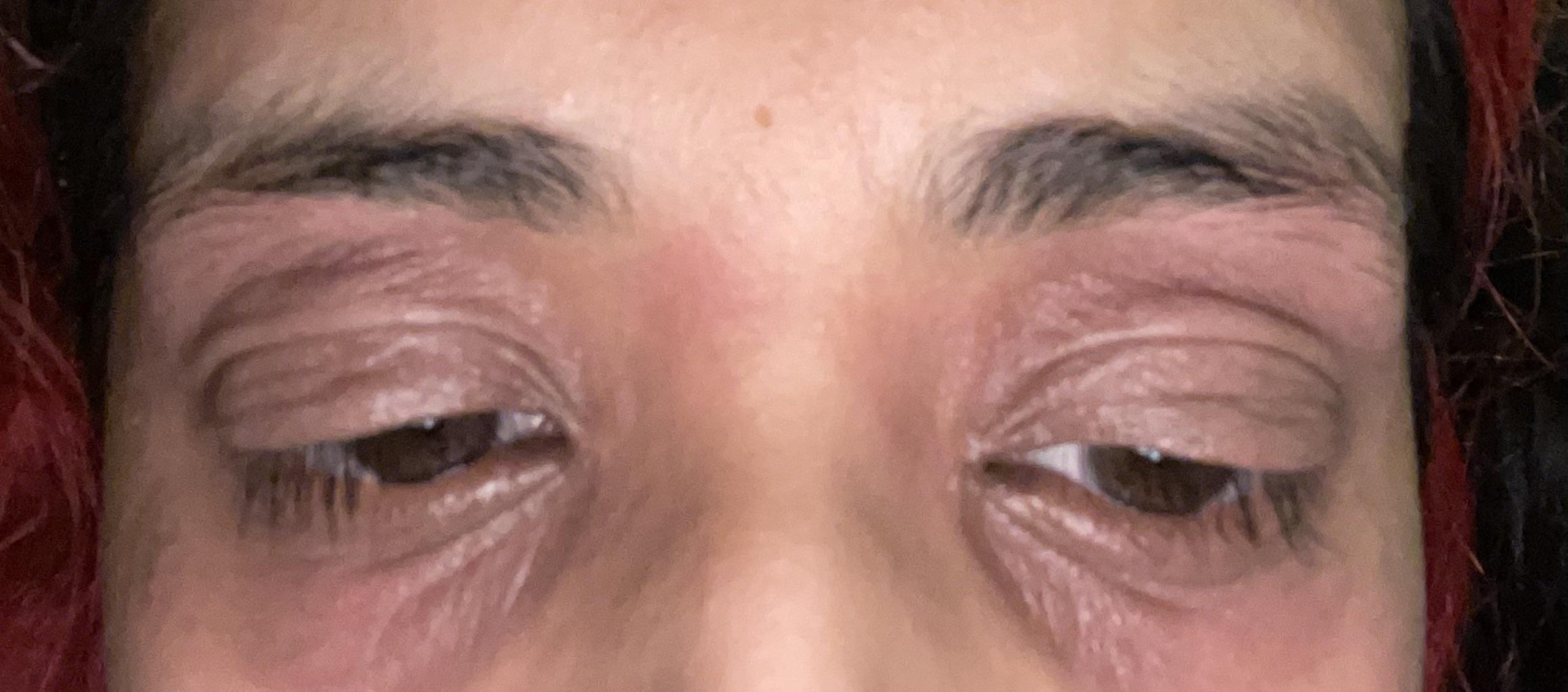 Literally sick of having eczema around my eyes, how on earth do I show