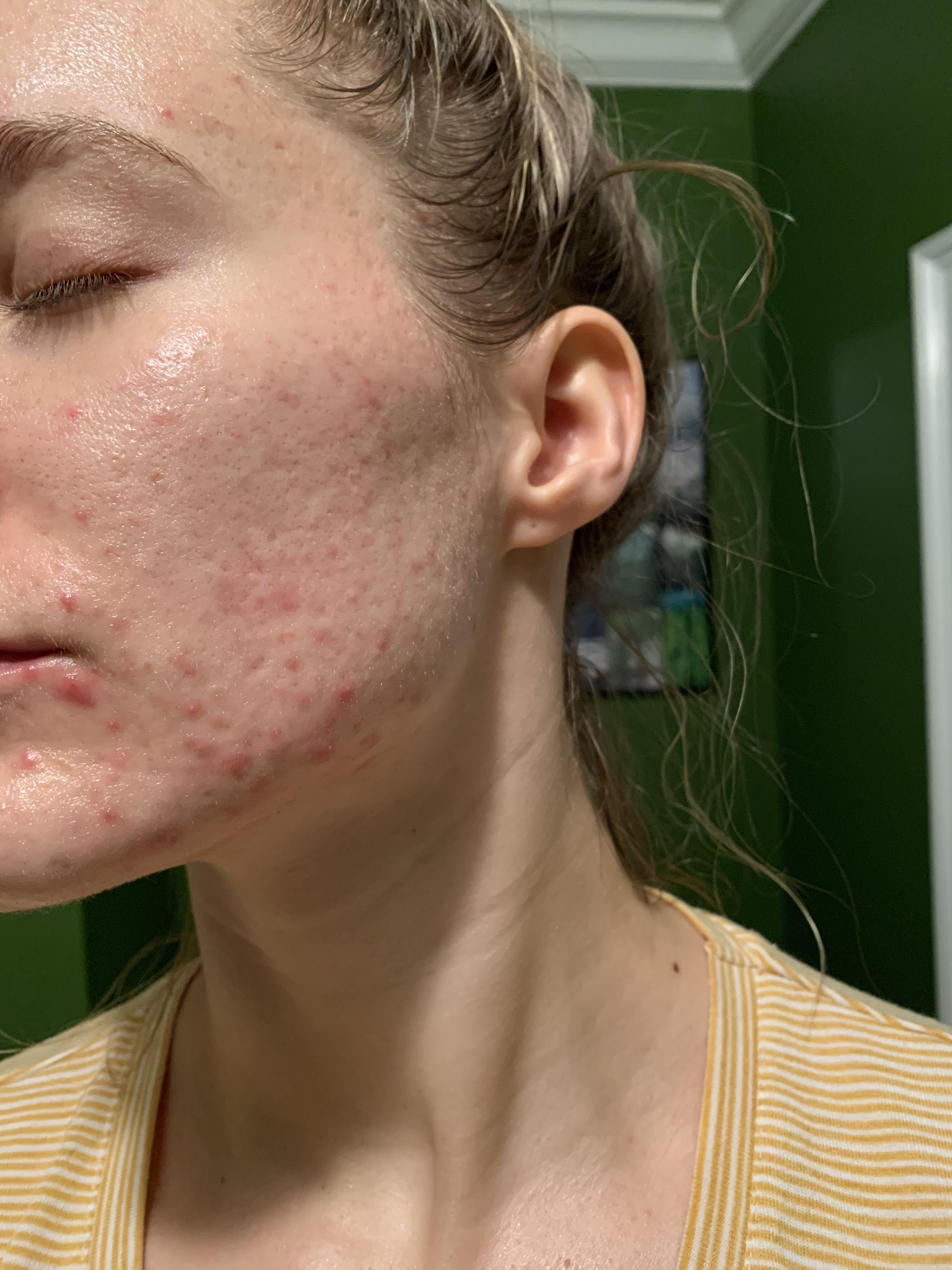 [Routine Help] Damaged skin barrier or should I use more acids to clear