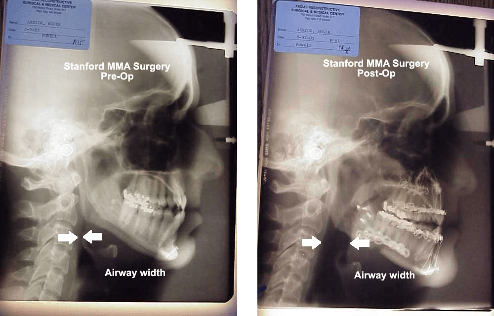 Before vs after jaw surgery for sleep apnea r/Damnthatsinteresting