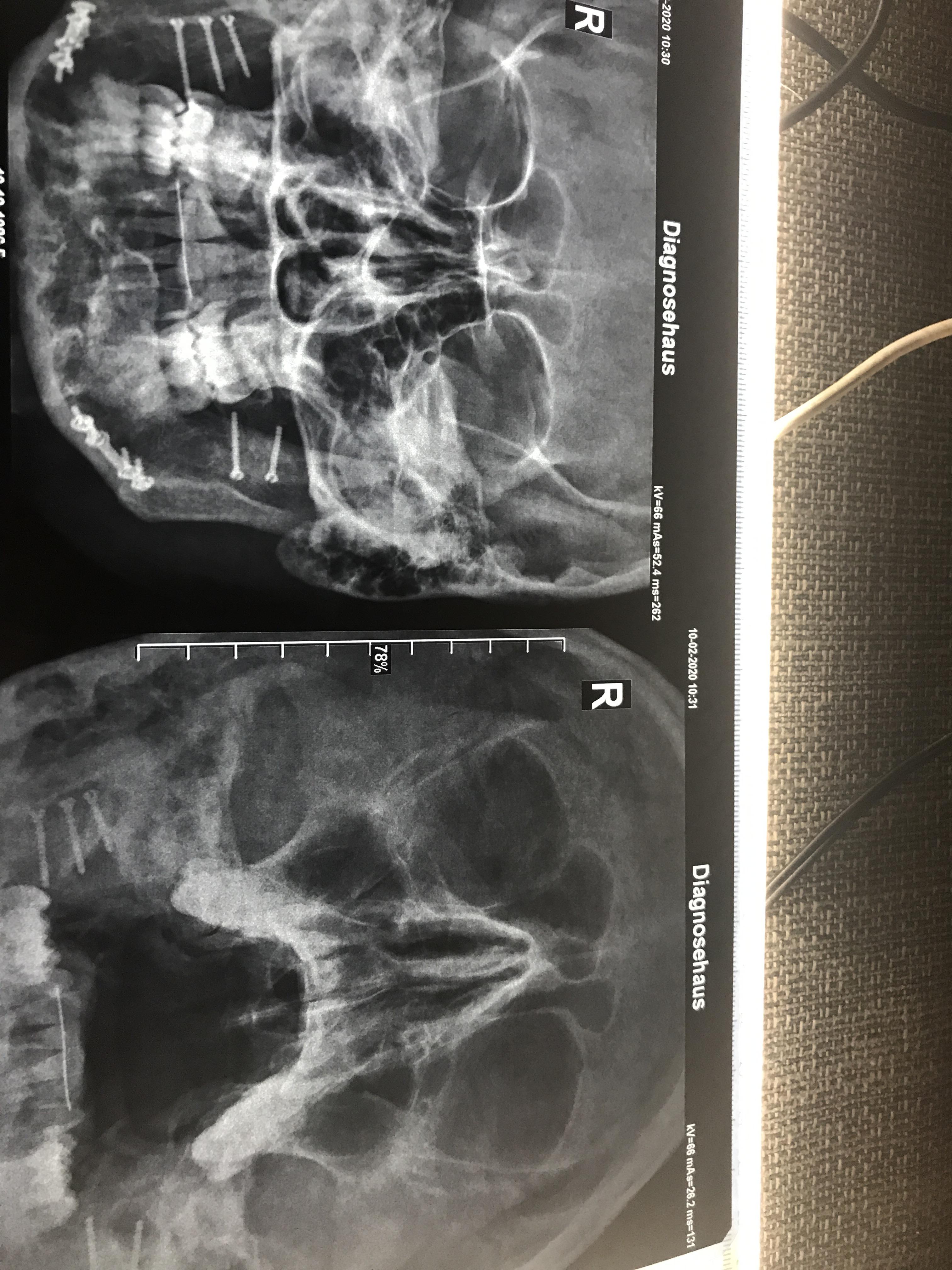 I have emanating pain on the left side of my face. I think the focus is