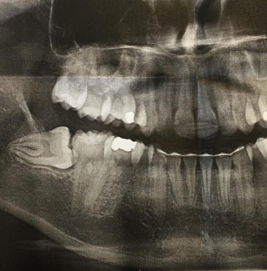 My lovely wisdom tooth that I’ll have for another 34