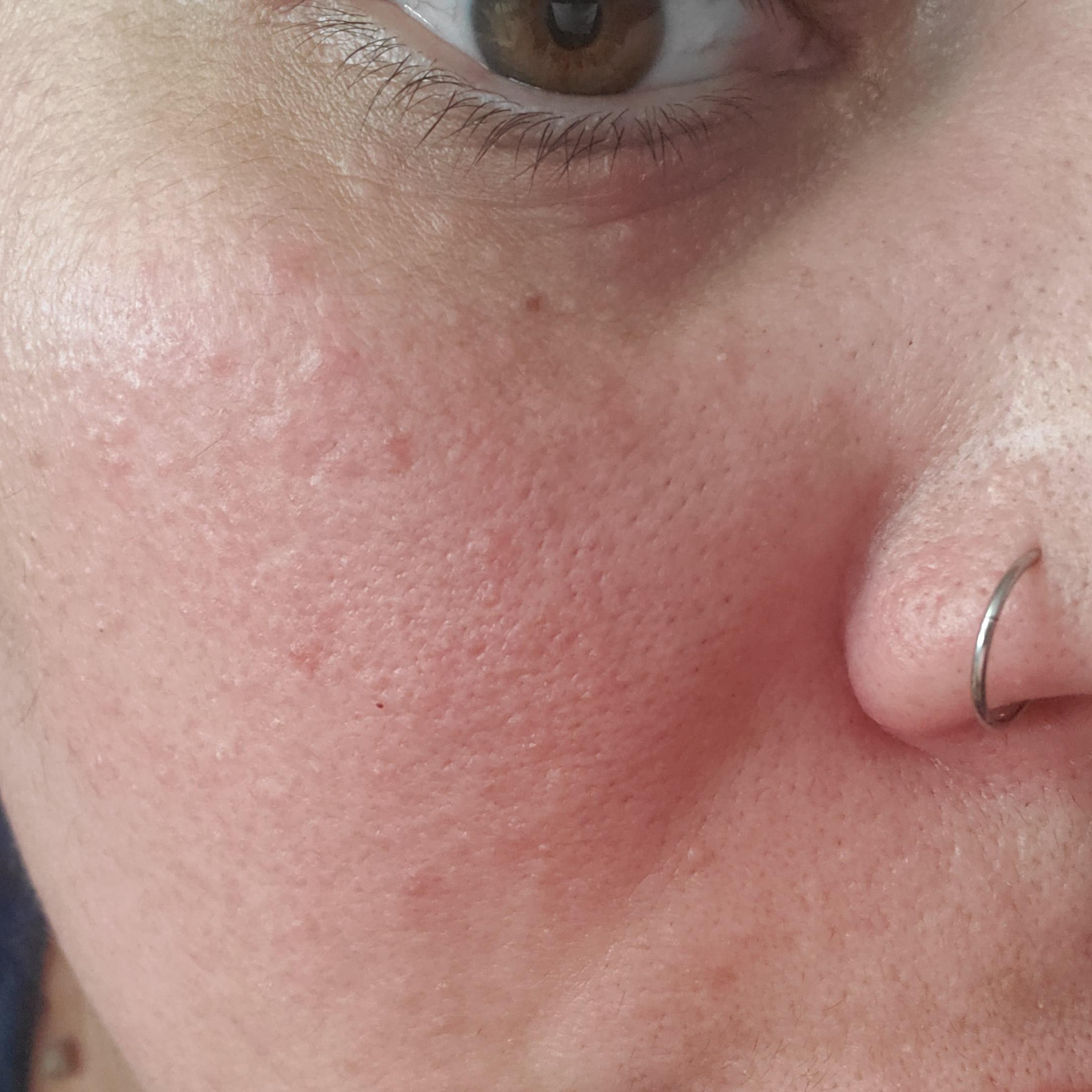 Spots under my left eye r/30PlusSkinCare