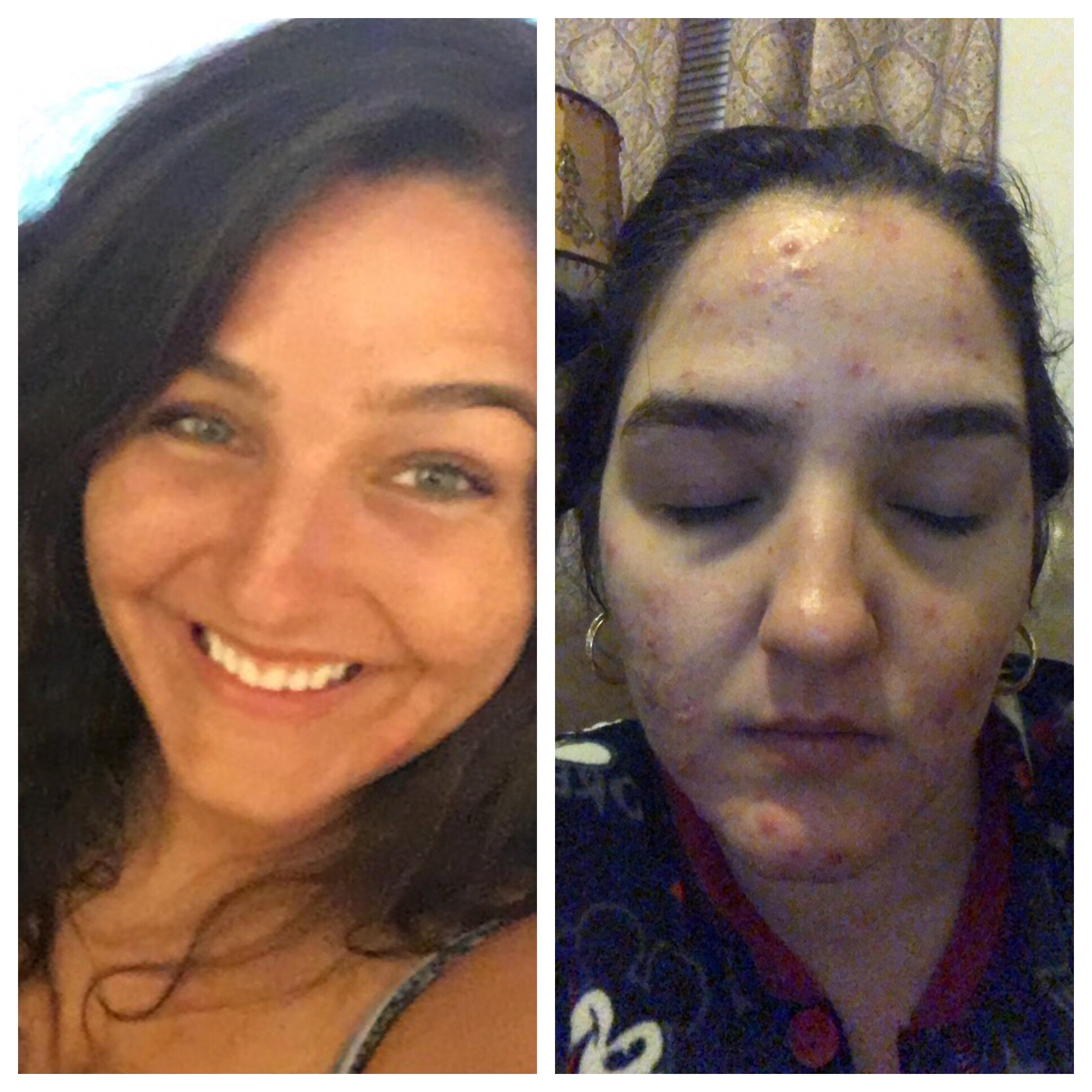Kyleena IUD and HORRIBLE Acne 6 Months PostInsertion? r/birthcontrol
