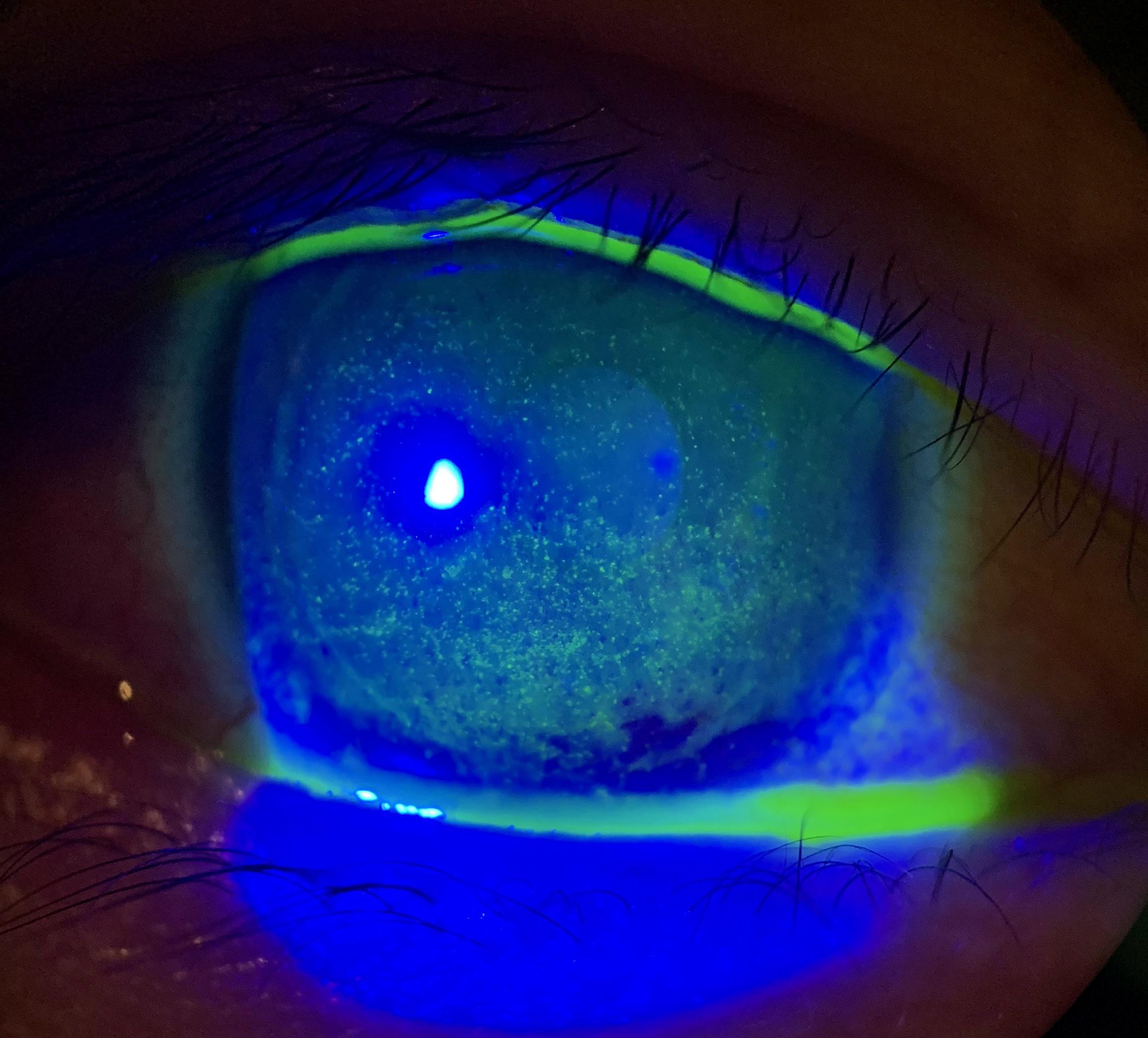 Corneal keratitis r/optometry