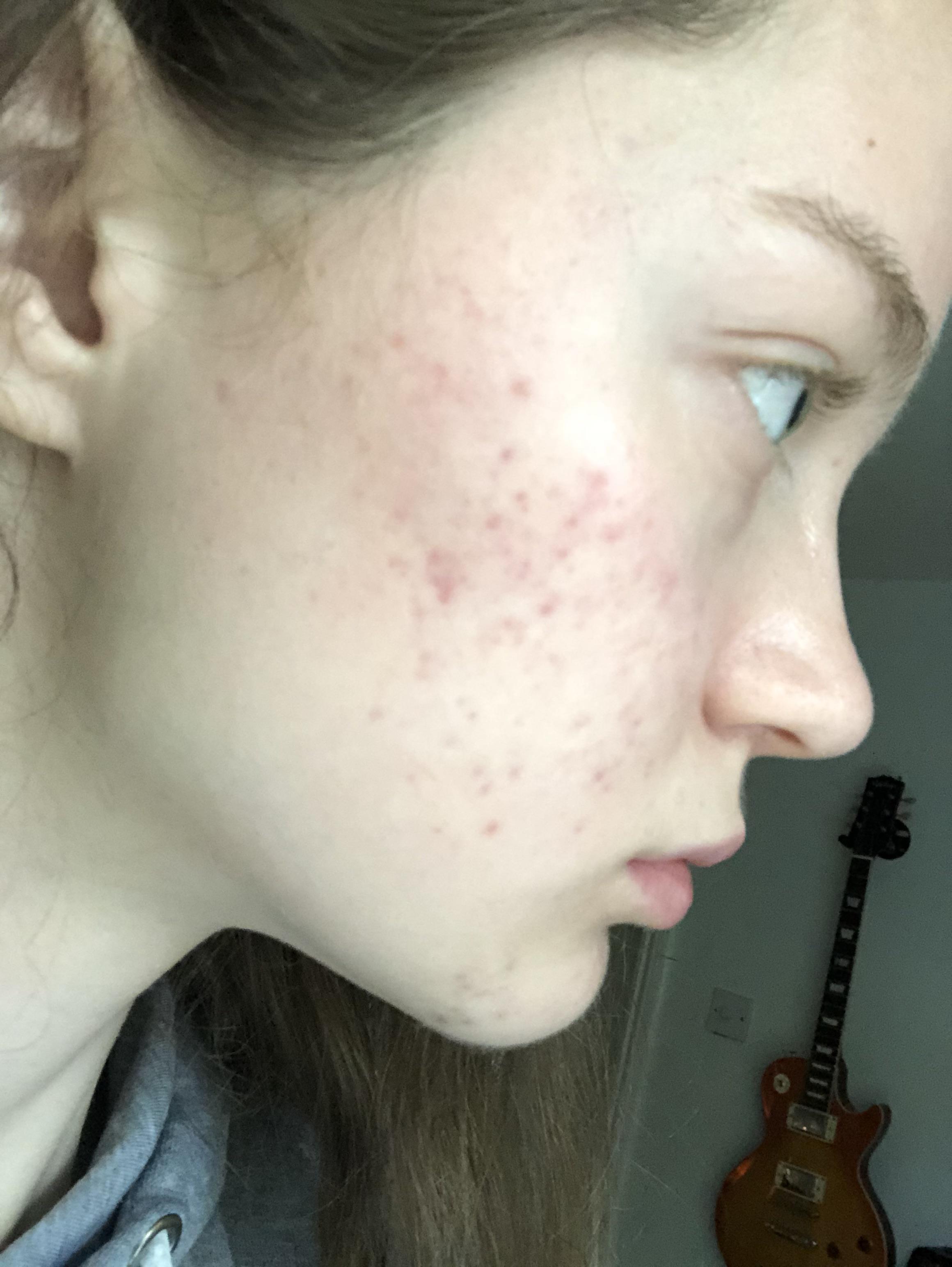 Please help me to fade my red marks / scars / PIE leftover from acne
