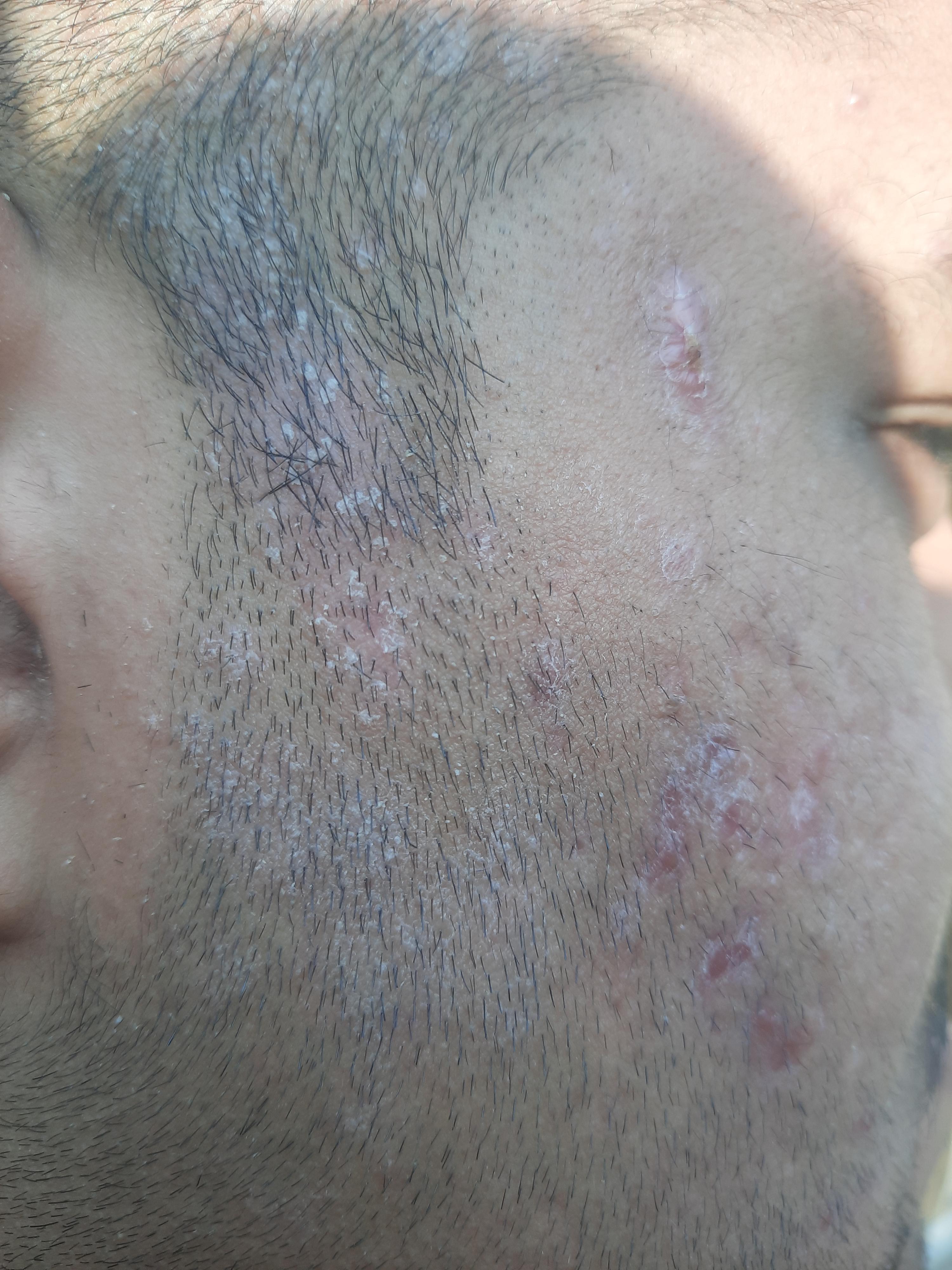 Been getting these white patches consecutively after getting haircuts