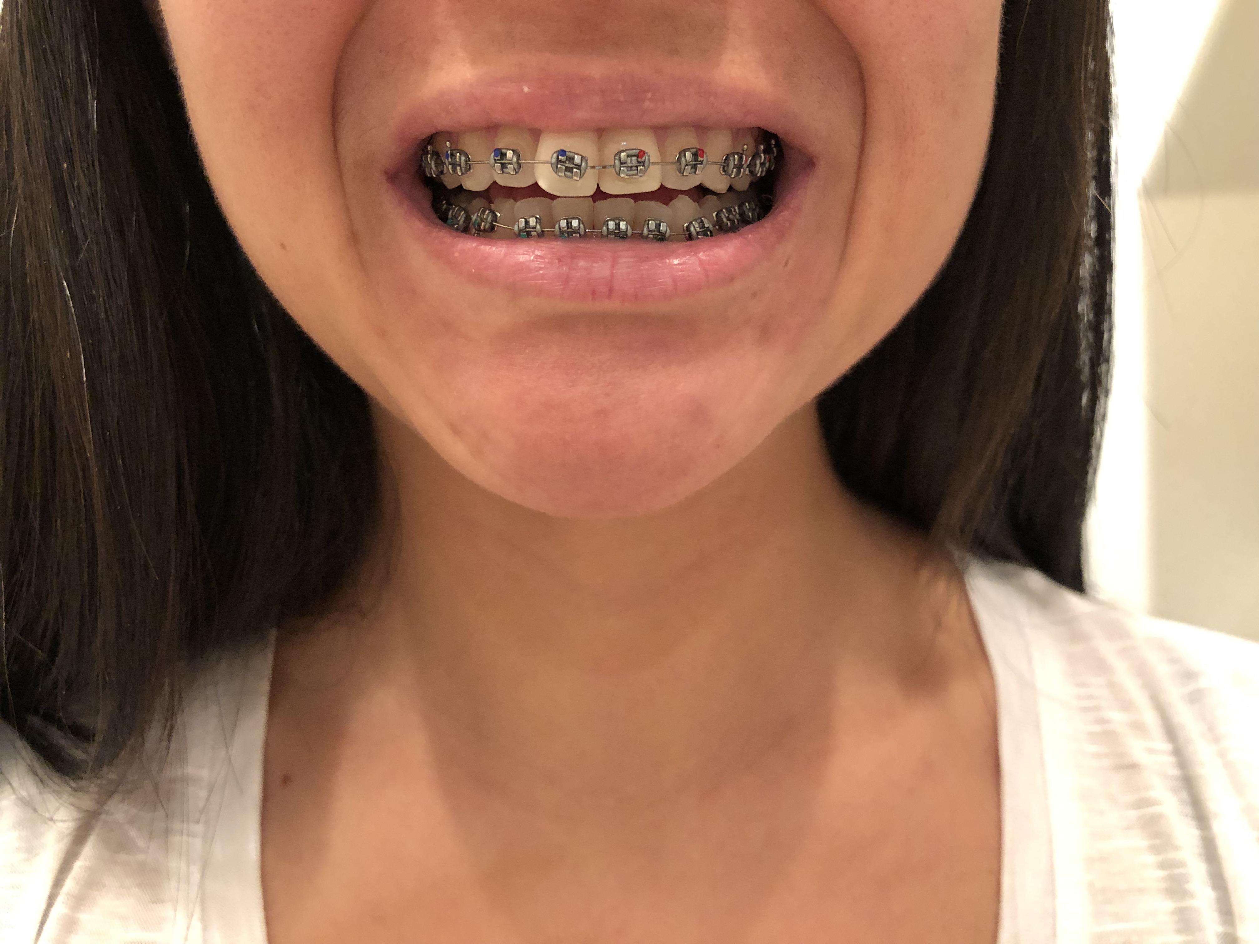 Just got my braces on today! About 4 hours ago to be exact. I’ve seen