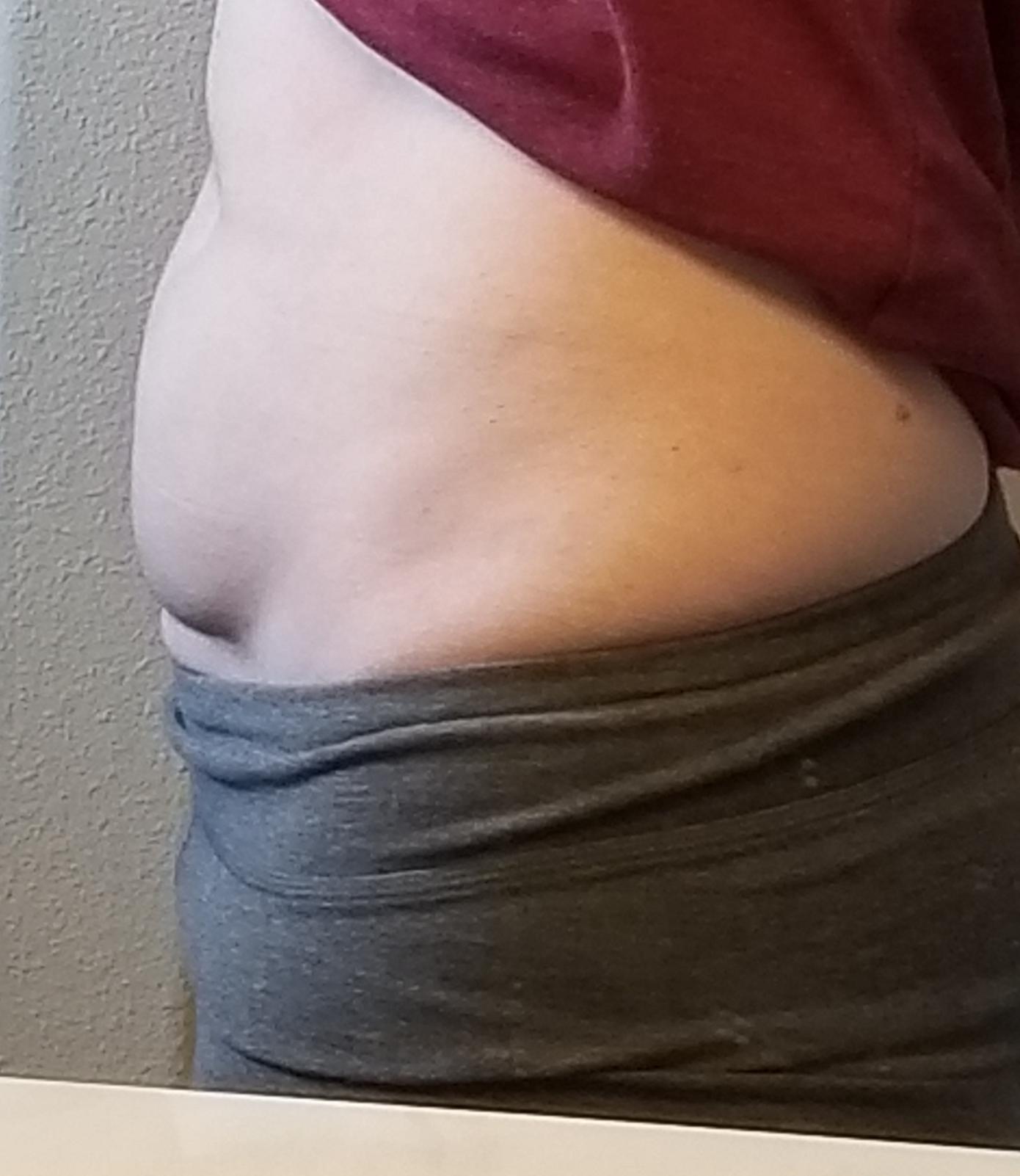 Liposuction or tummy tuck after a hysterectomy? Does anyone else have