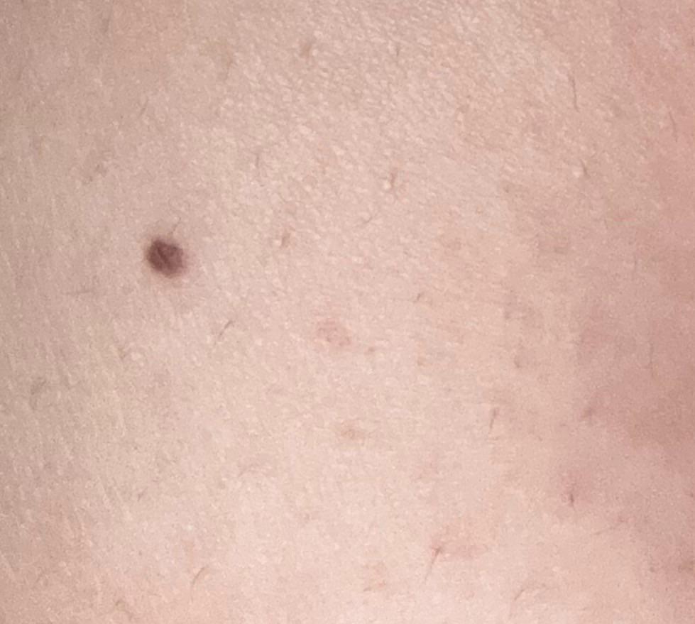 Brown spots on stomach r/DermatologyQuestions