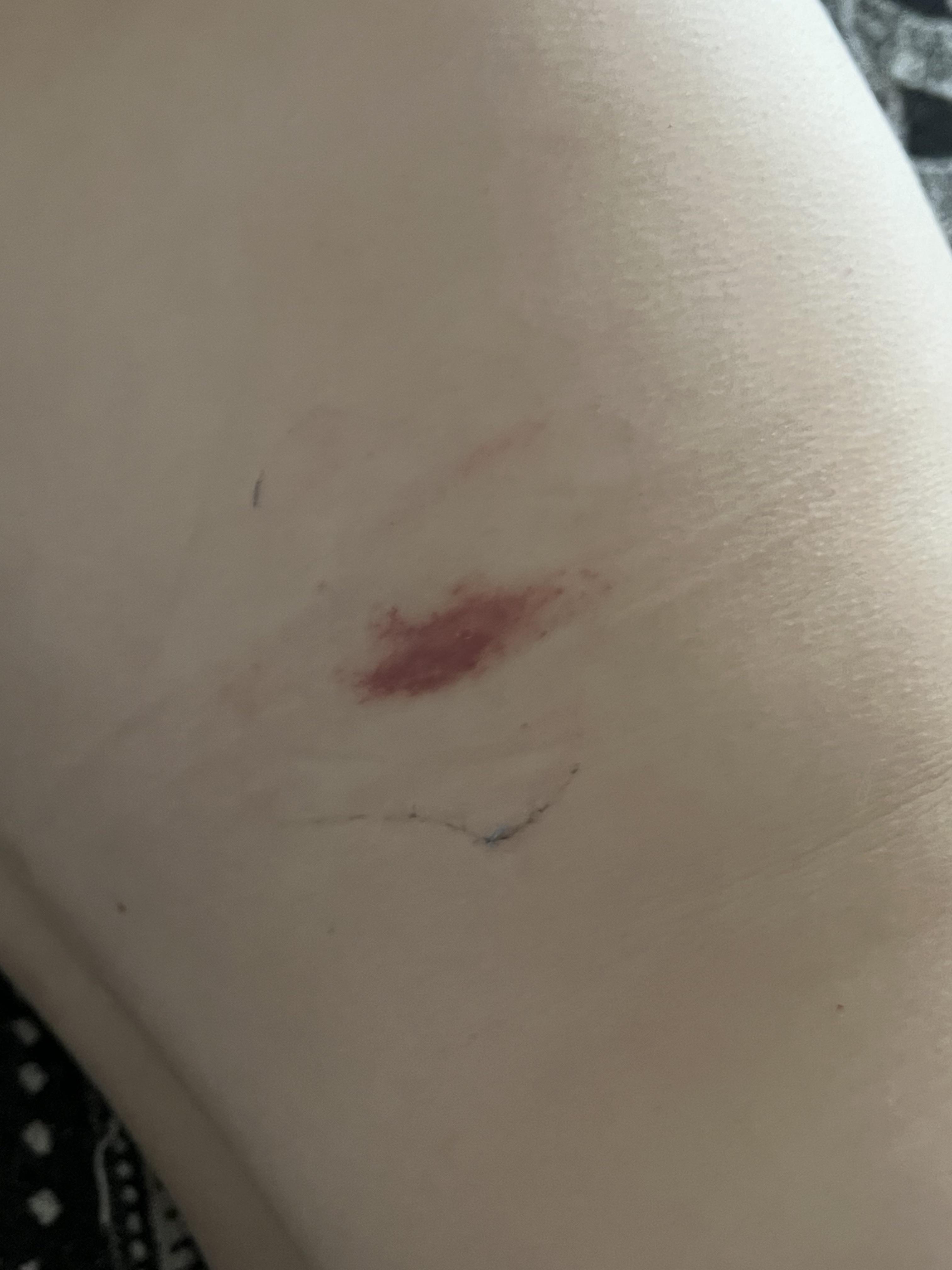 Should I be worried about this bug bite? r/medical