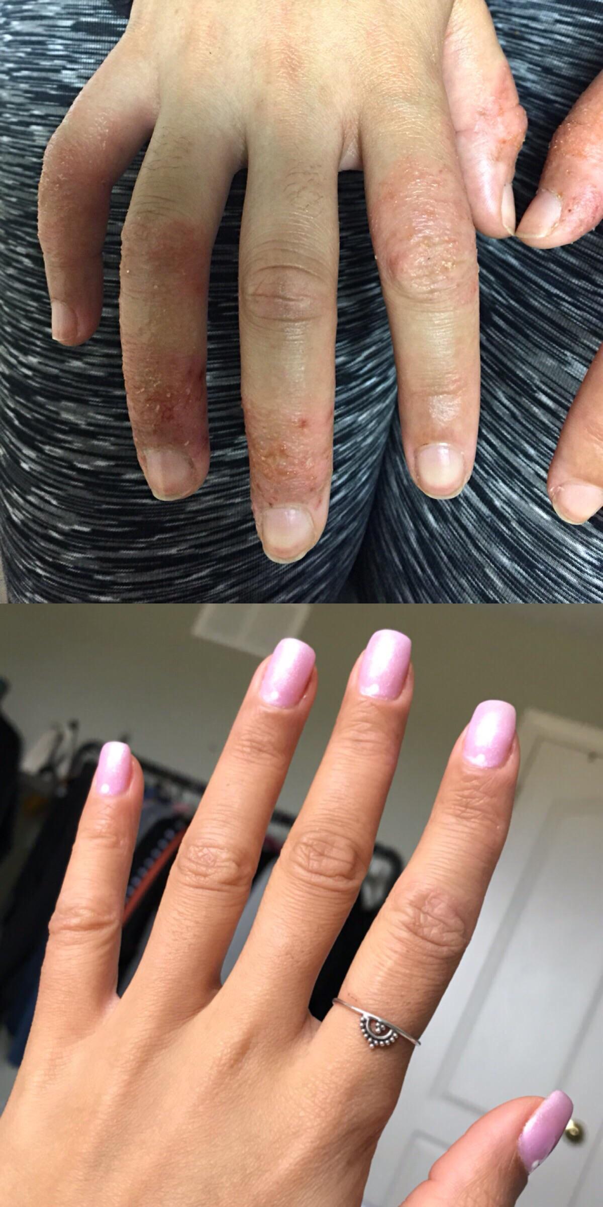 December 2015 to April 2019 progress. UV therapy (tanning), acrylic nails (for skin protection