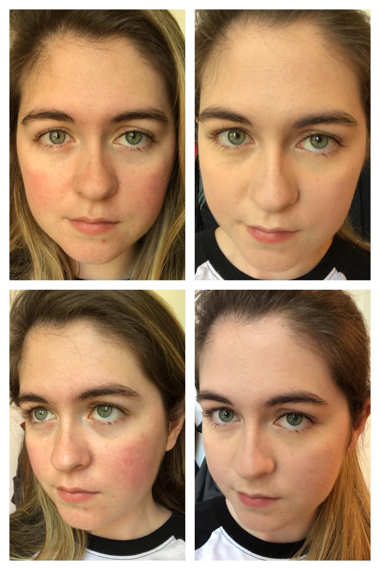 B&A My daily routine for covering rosacea! (still a work in progress