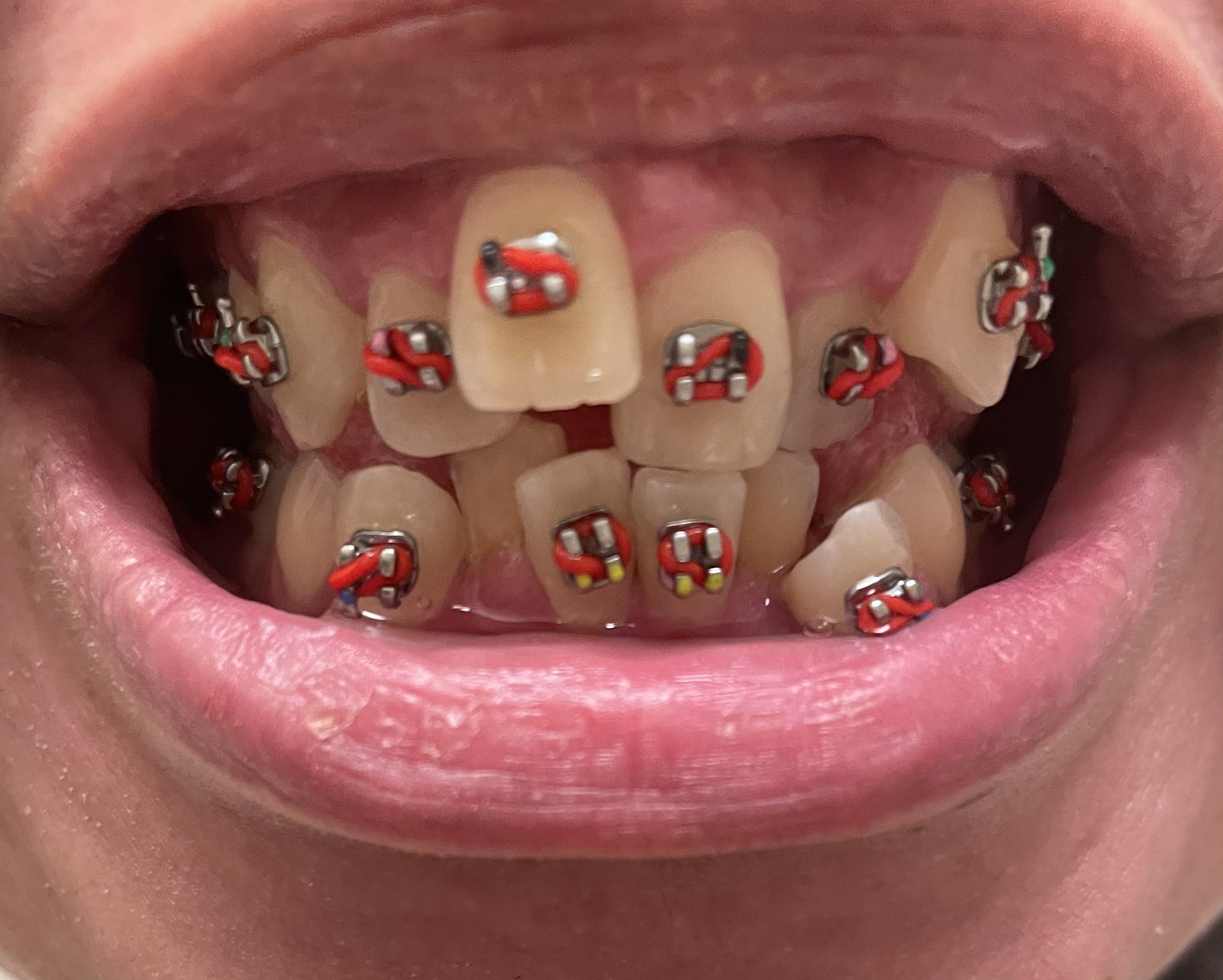 Whats the longest you might need braces for? braces