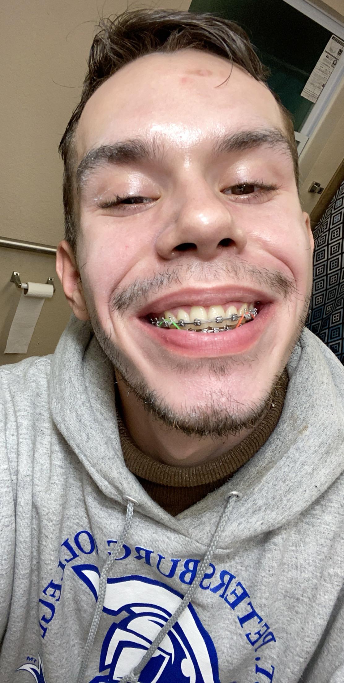 Do I have a gummy smile? I’m getting my braces off in February 27th and