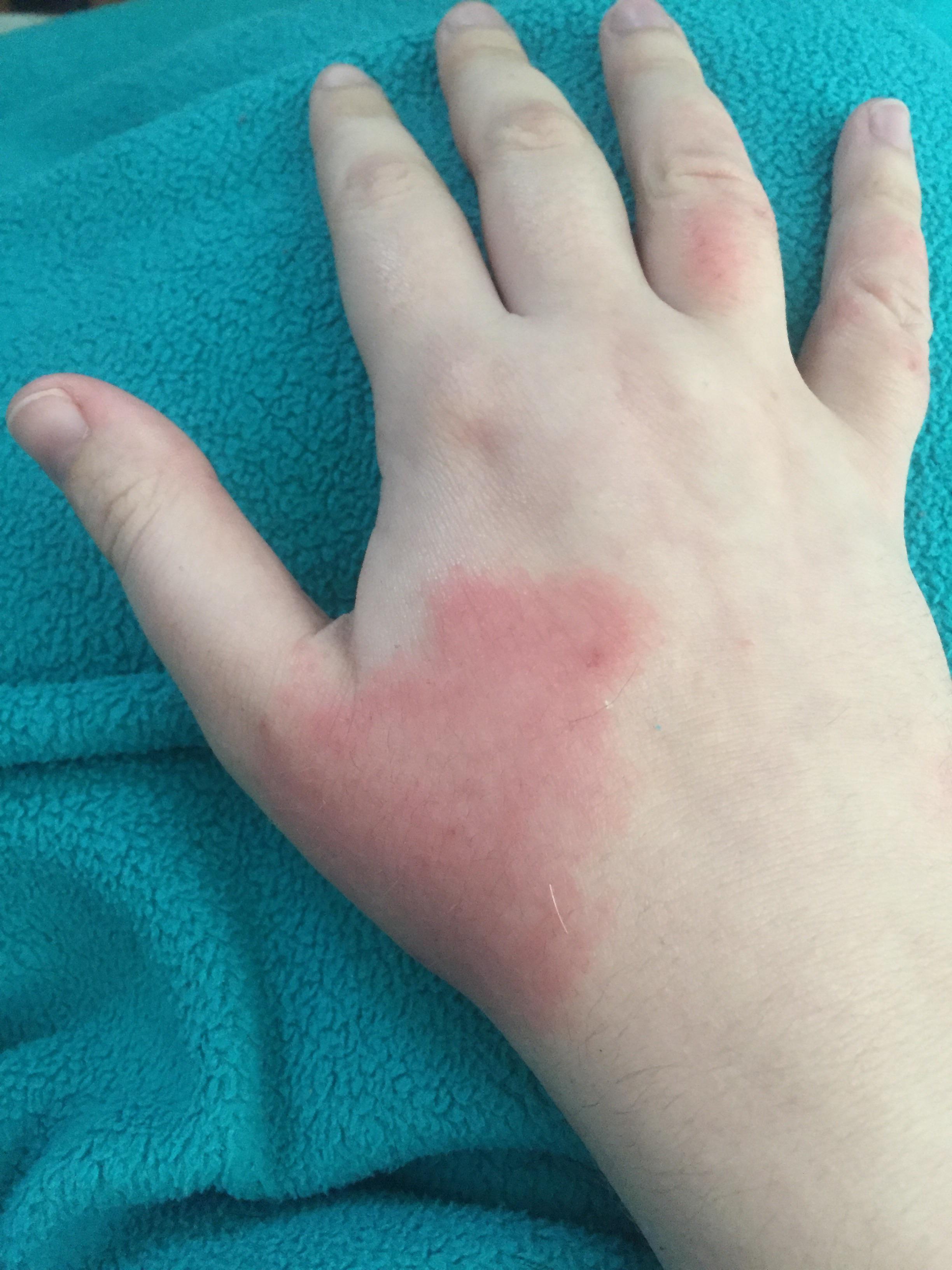 Skin Flare Up From Stress / During inflammatory eczema responses, the