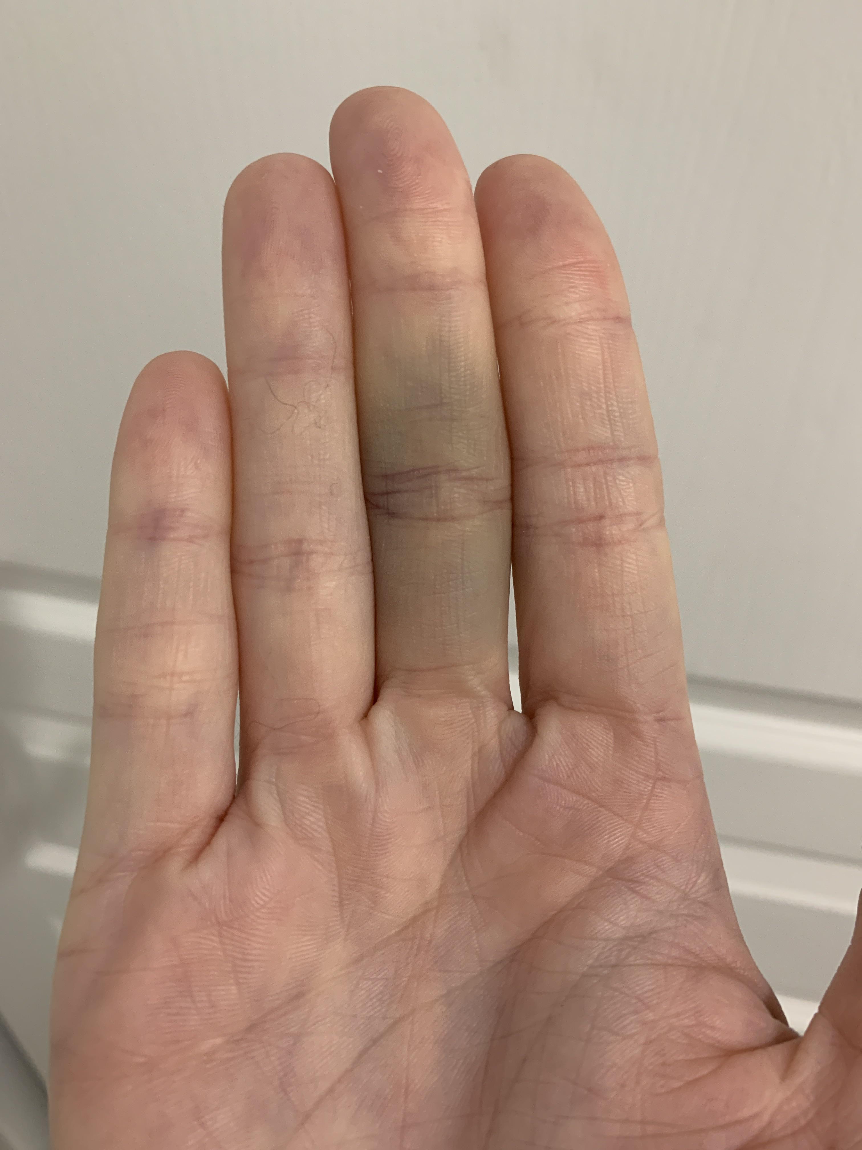 Bruised my finger vacuuming somehow r/Wellthatsucks