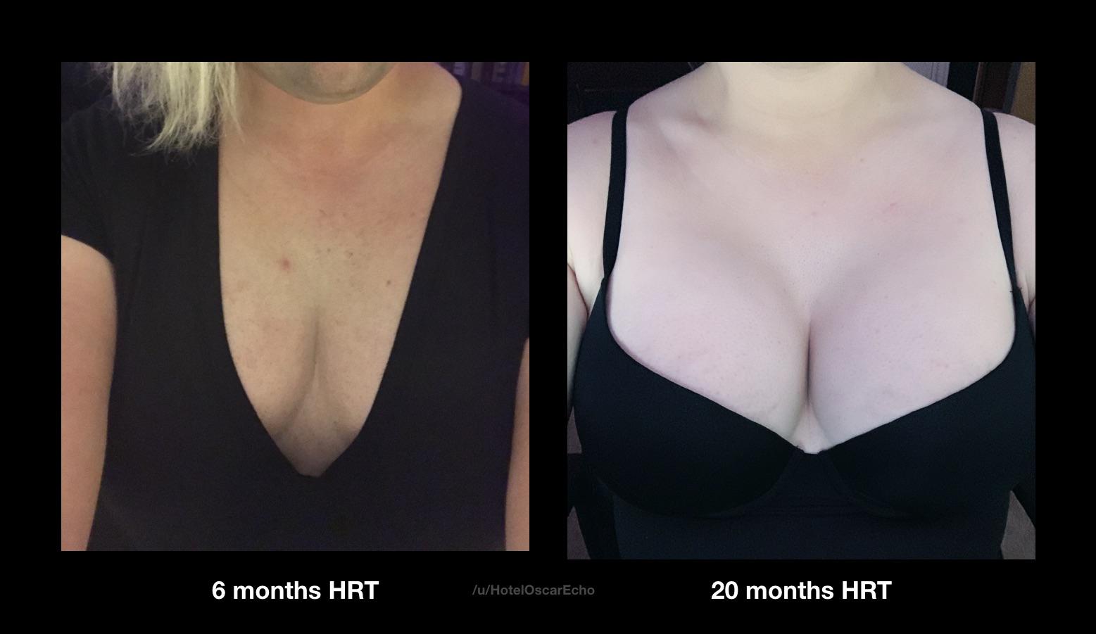 From 6 months, to 20 months HRT breast development (28yro, No surg