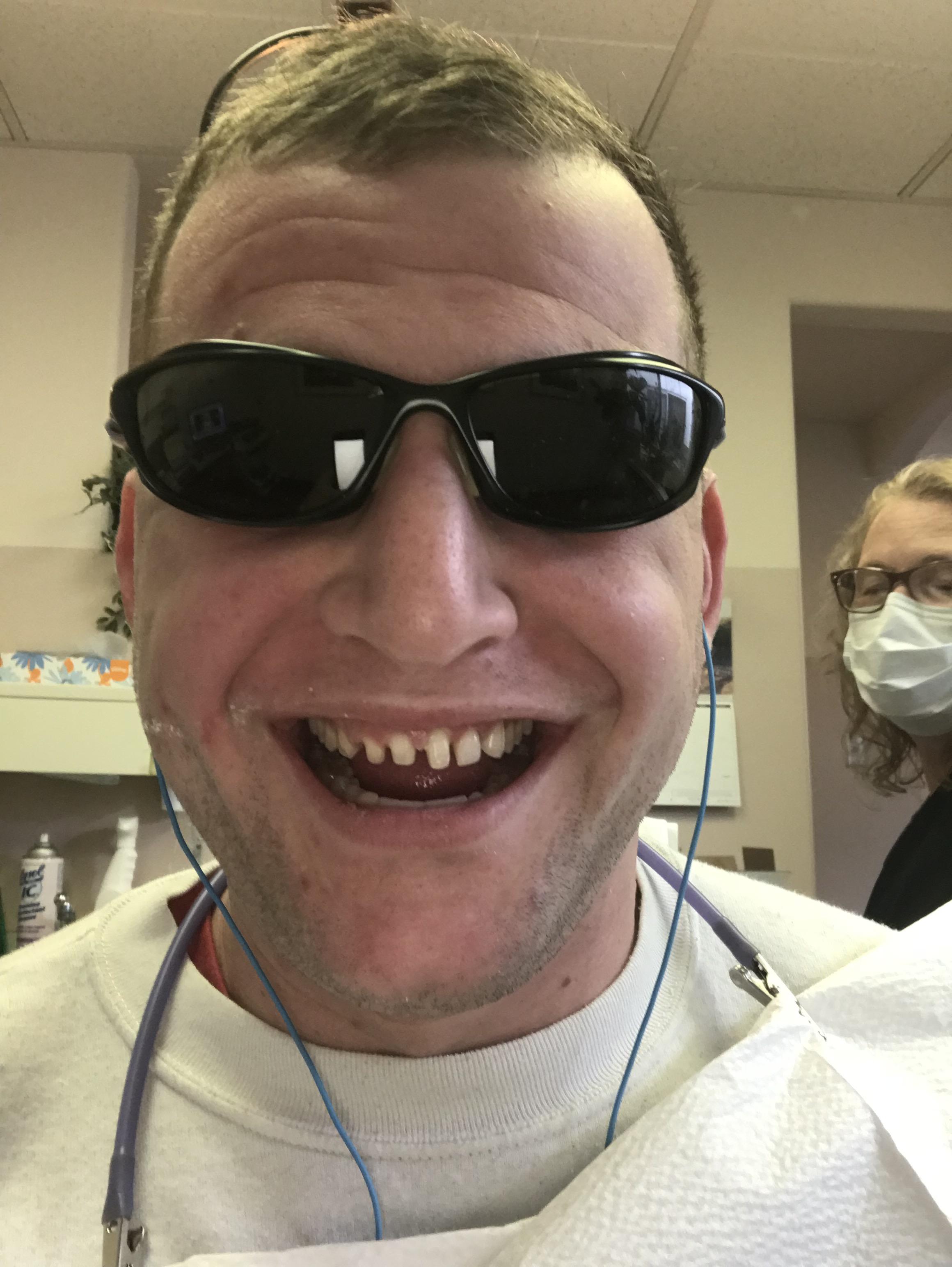 In the process of getting my veneers redone. r/pics