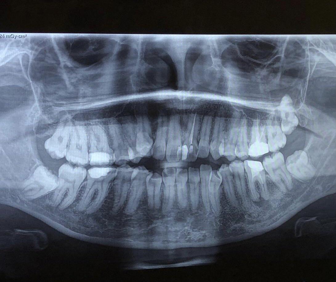 Can these wisdom teeth erupt after braces ? r/askdentists