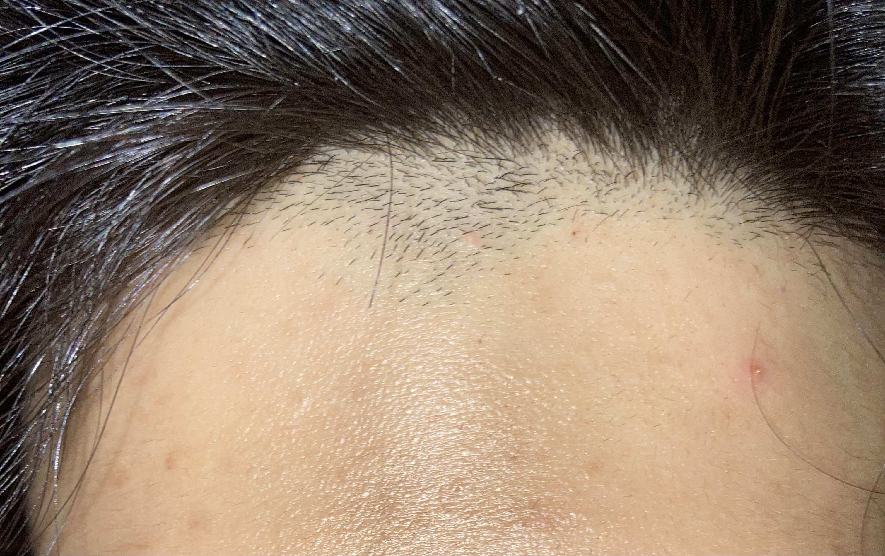 HELP ! I went to some barber two weeks ago, and now my hairline is looking like this... How can