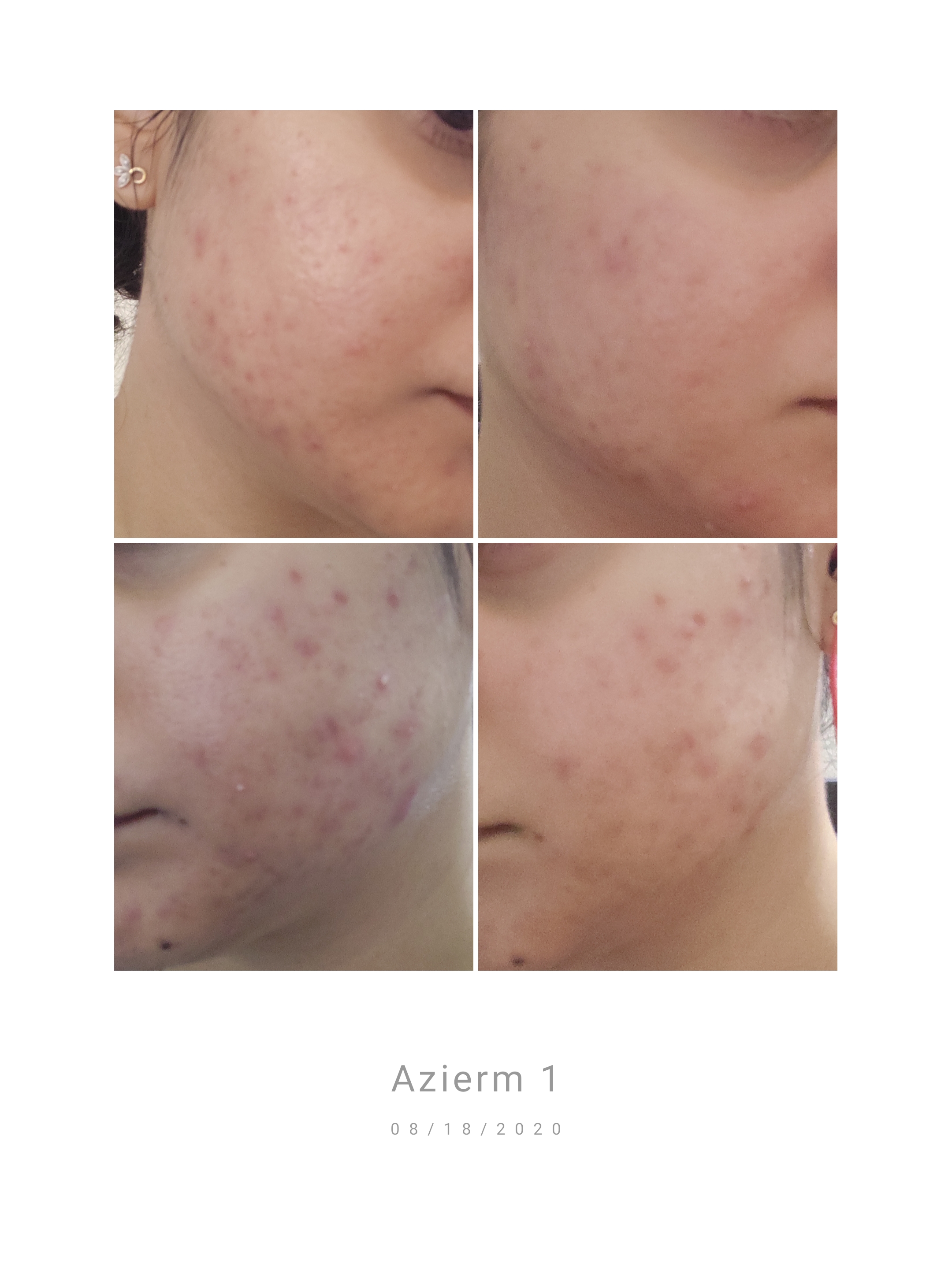 A week on azelaic acid. Do I see progress or is it just in my head? Before After r
