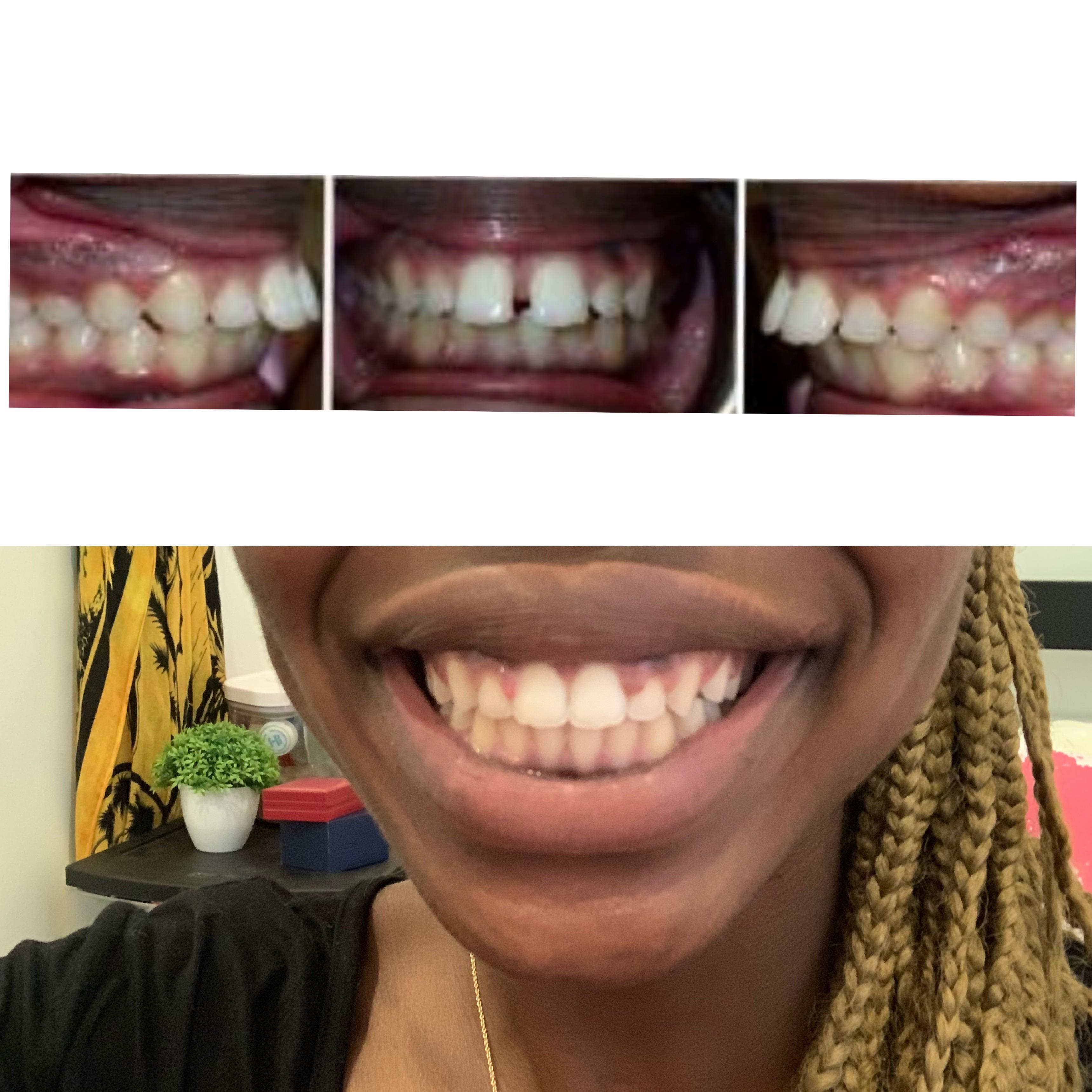 Braces off after 22 months! Help w gum swelling/bleeding? r/braces
